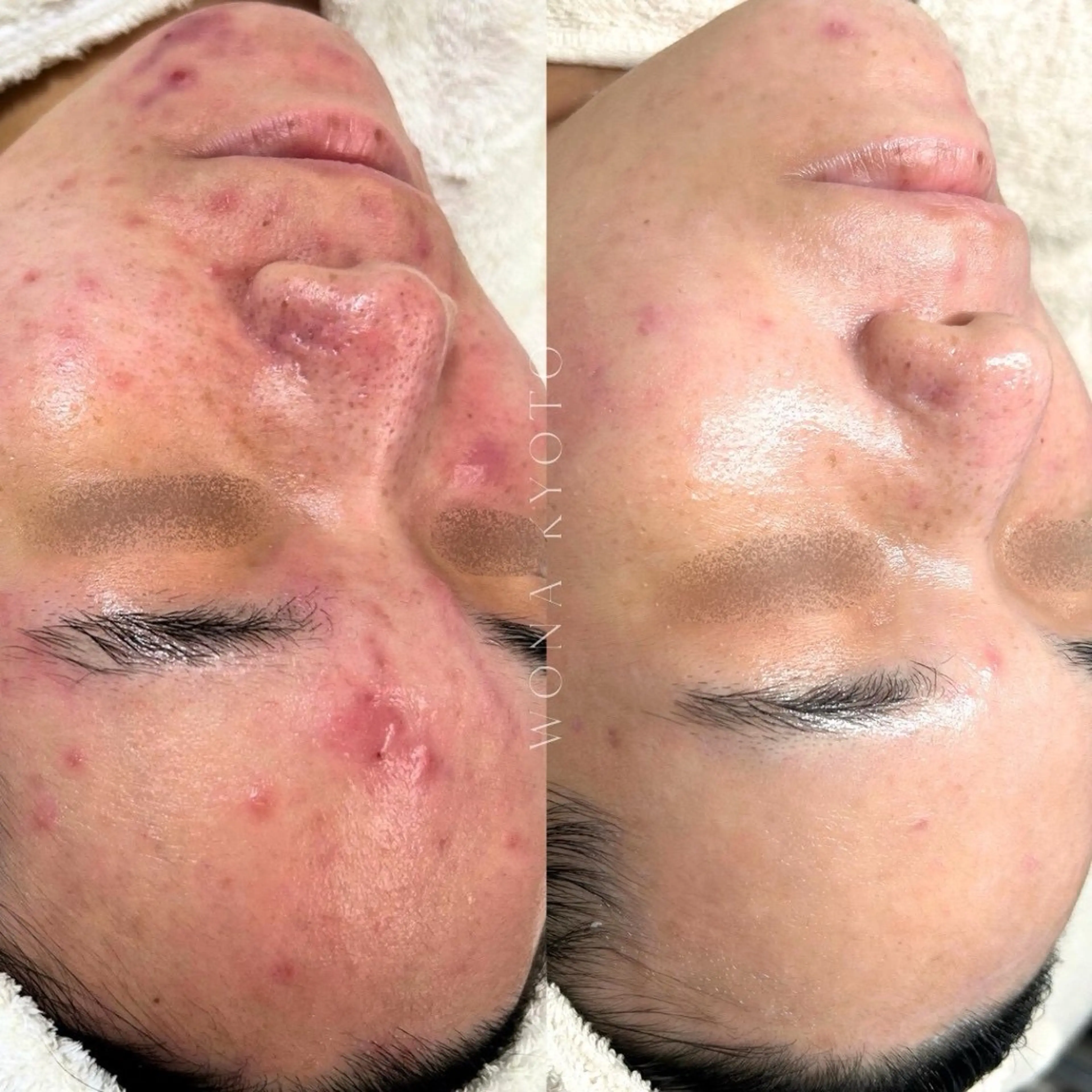 【複合的なお肌悩みを一度に解決スペシャルケア】ベルドソ×アクアピール×白玉酸素セラピー【鎮静、赤ら顔、毛穴、肌の再建】の写真