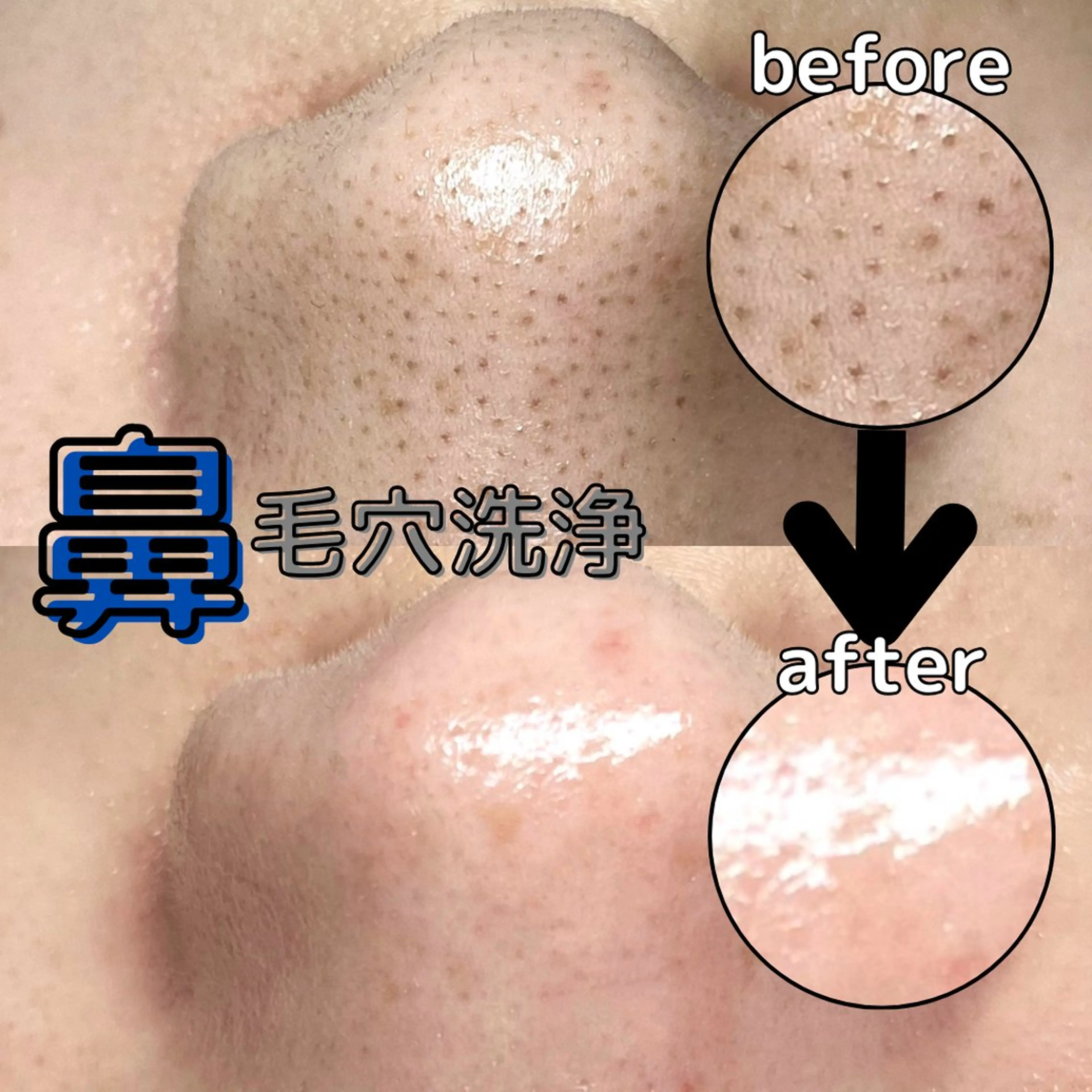 特別価格✨️🍓同時施術可能🍓【鼻だけ！👃毛穴洗浄‪💧‬】⏰45分の写真