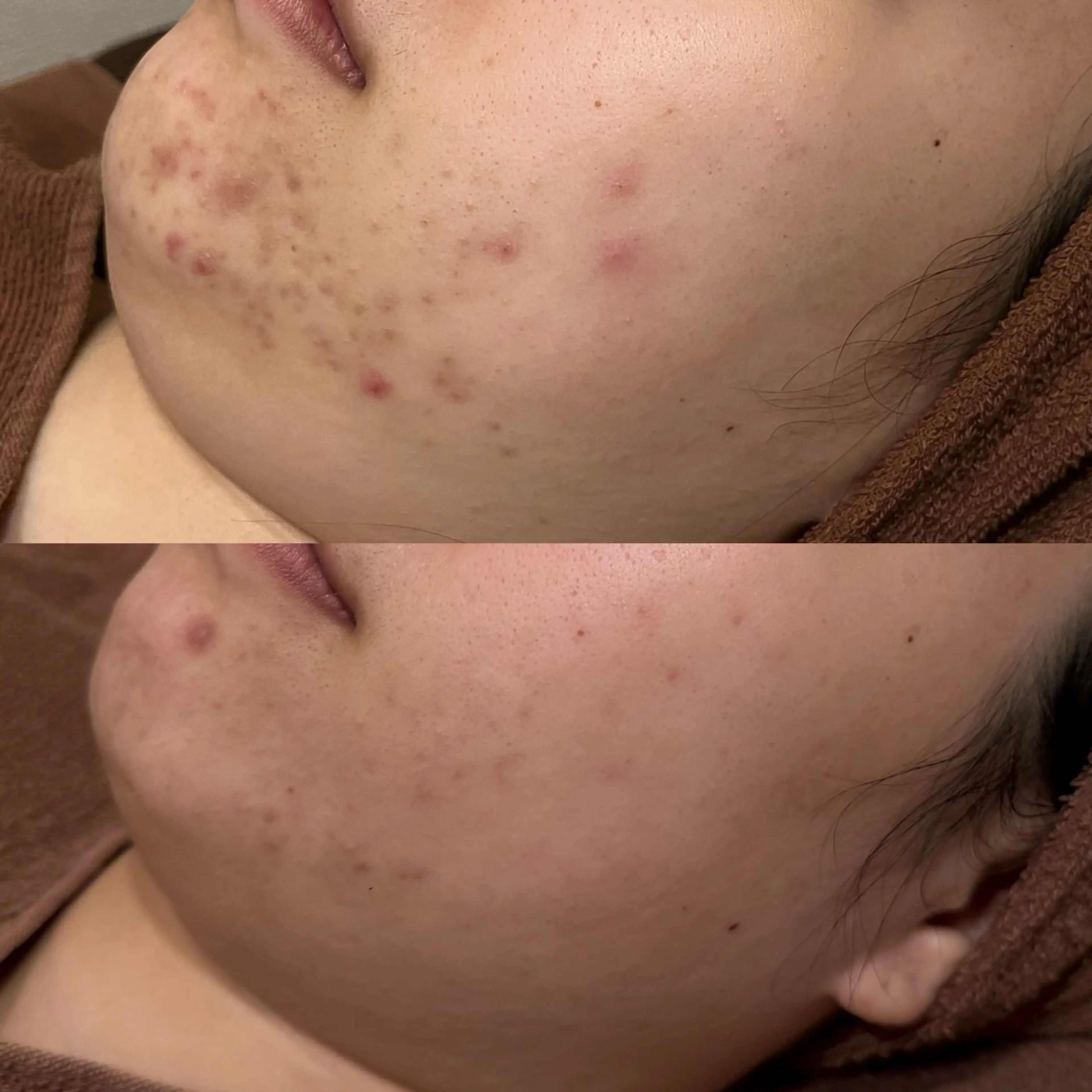 ダウンタイムなし🌷 優しい肌質改善のエステ・リラクイメージ