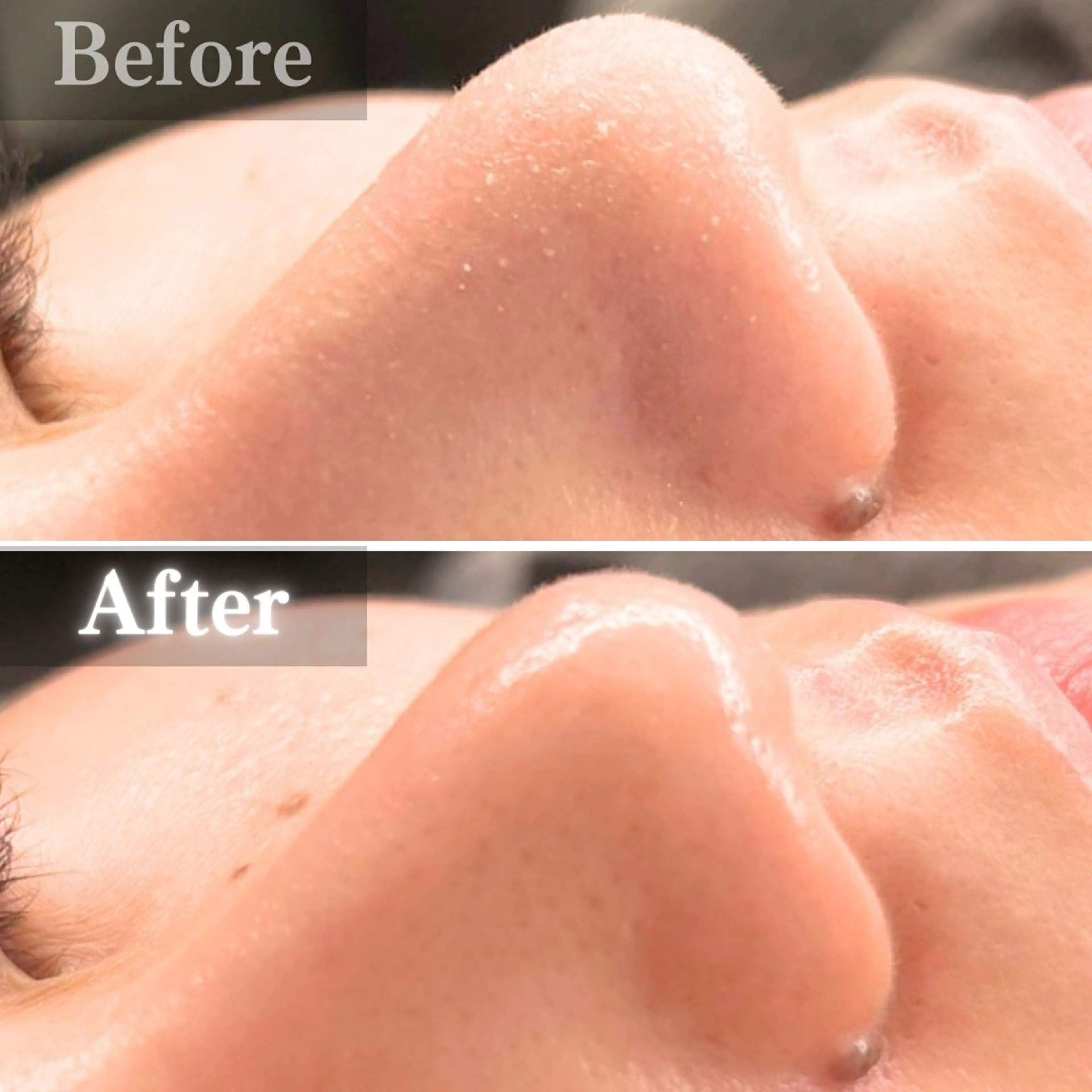 【角栓汚れゴッソリ!】毛穴洗浄(顔全体〜首) ×ヒト幹細胞超音波美容液導入の写真