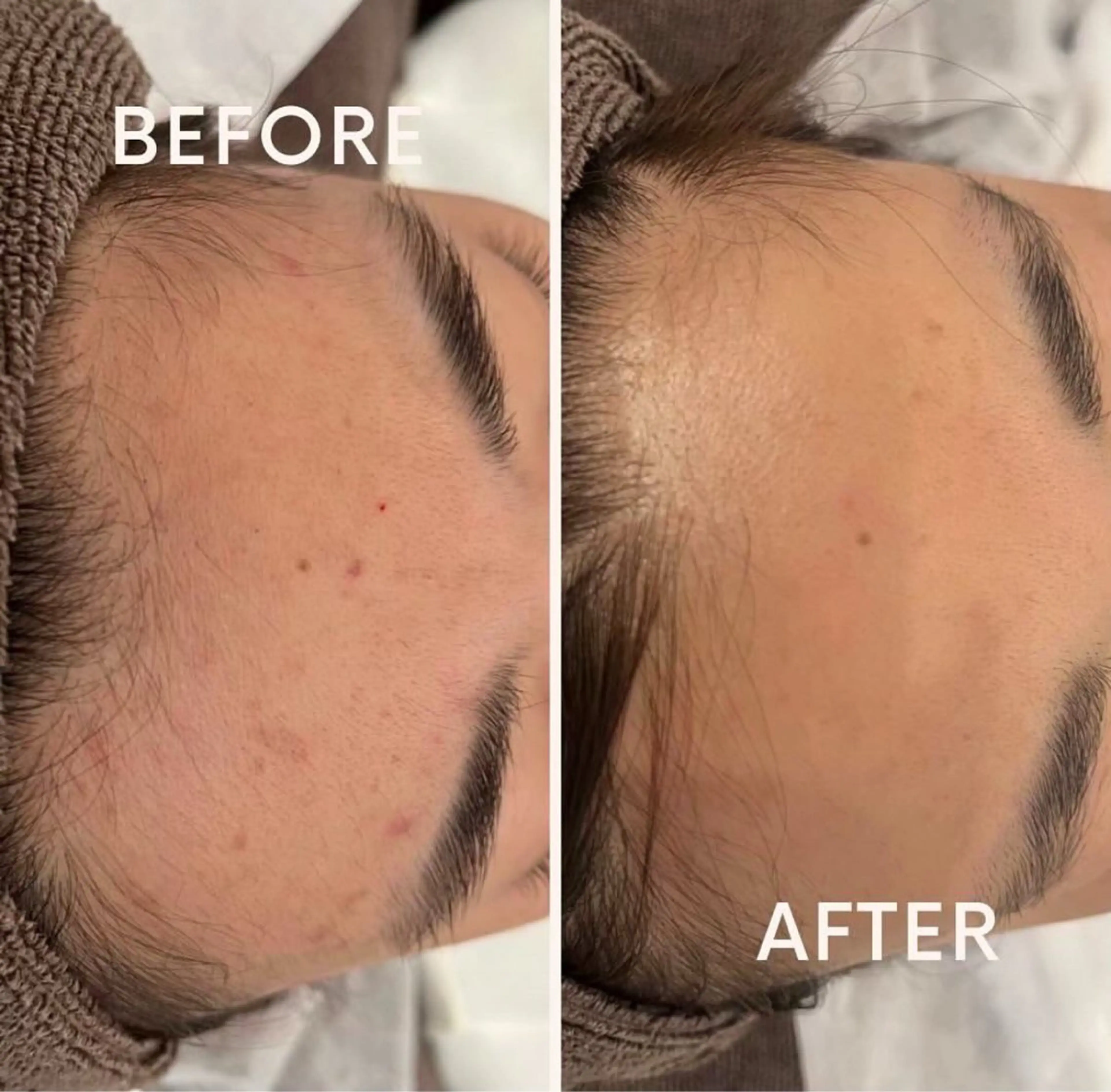 【京都市最安値】美肌顔脱毛✨の写真