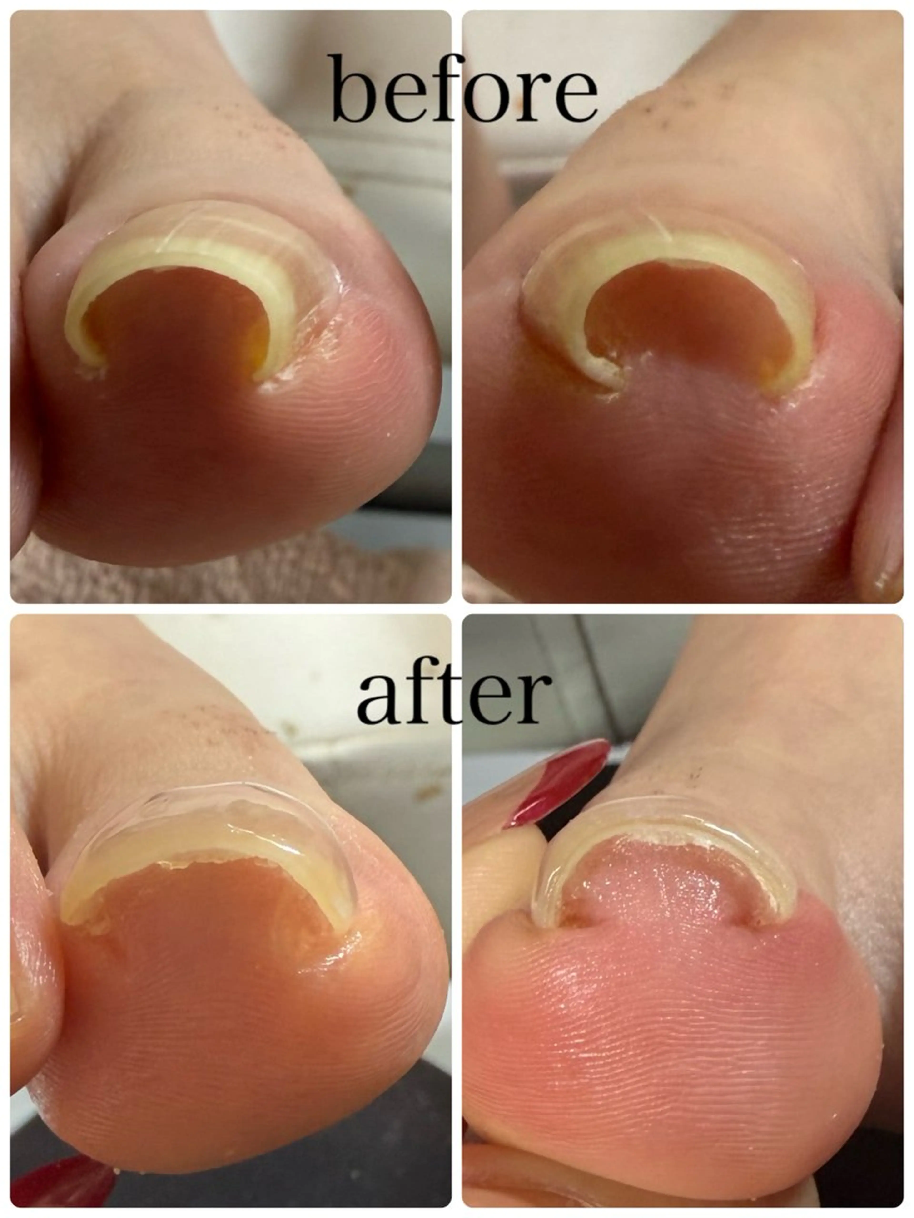 【オフあり】巻爪緩和コース✨️2本(親指)¥6000-/1本¥3000-/お時間は両足分✨️の写真