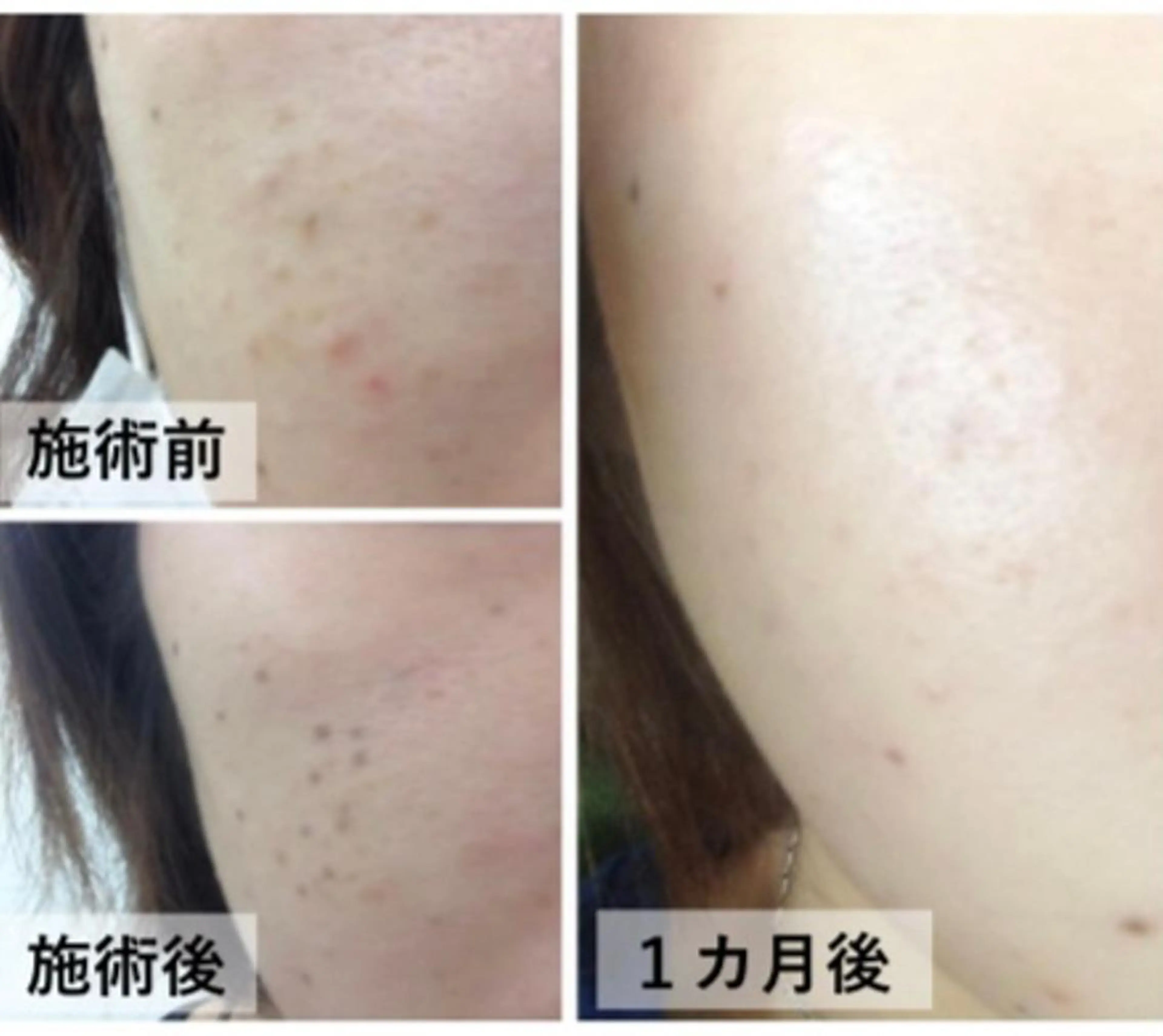 シミケアデトックス　10分当て放題（20箇所迄）の写真