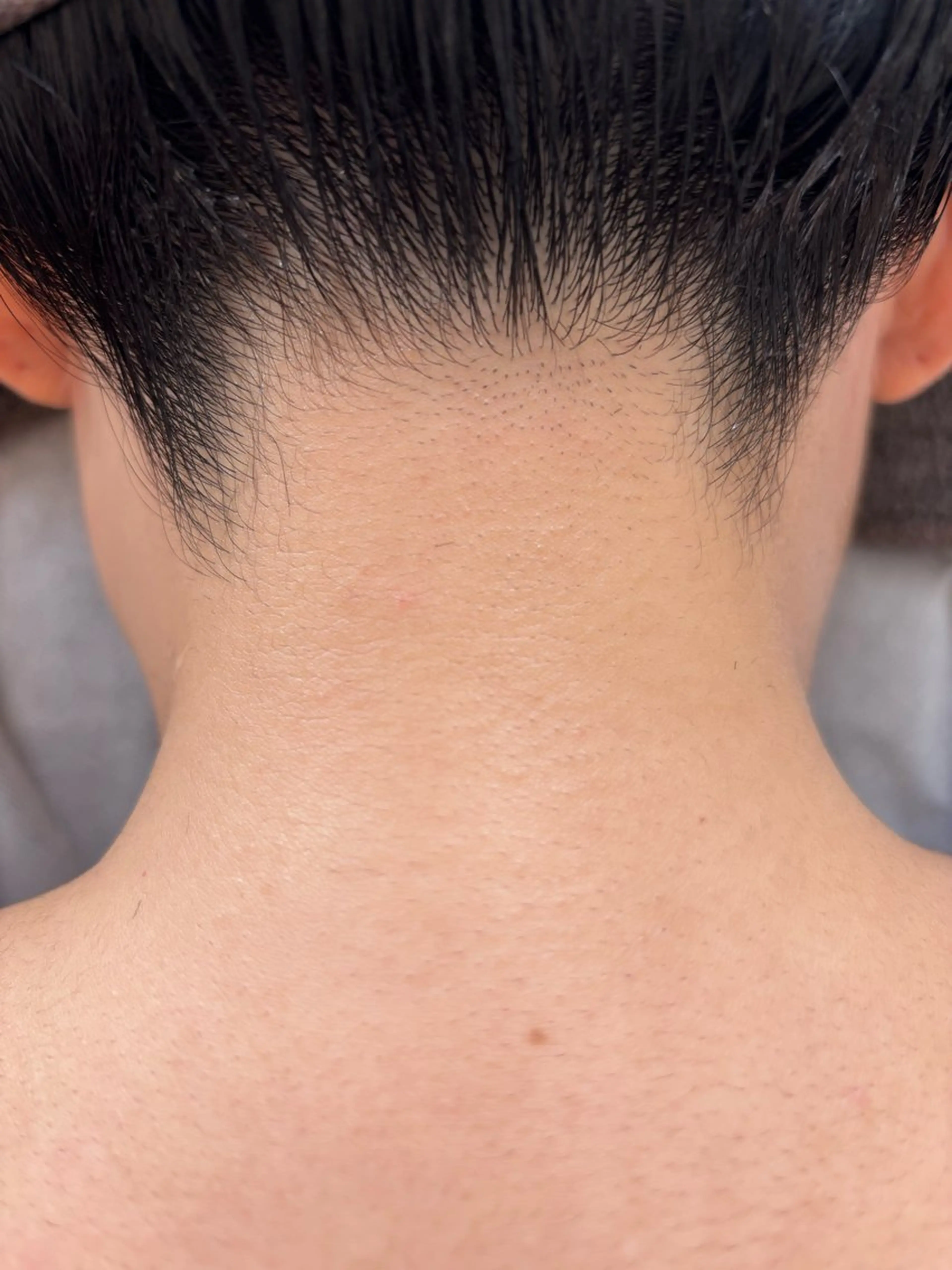 イオン導入顔脱毛＋襟足脱毛（無料シェービング付）の写真