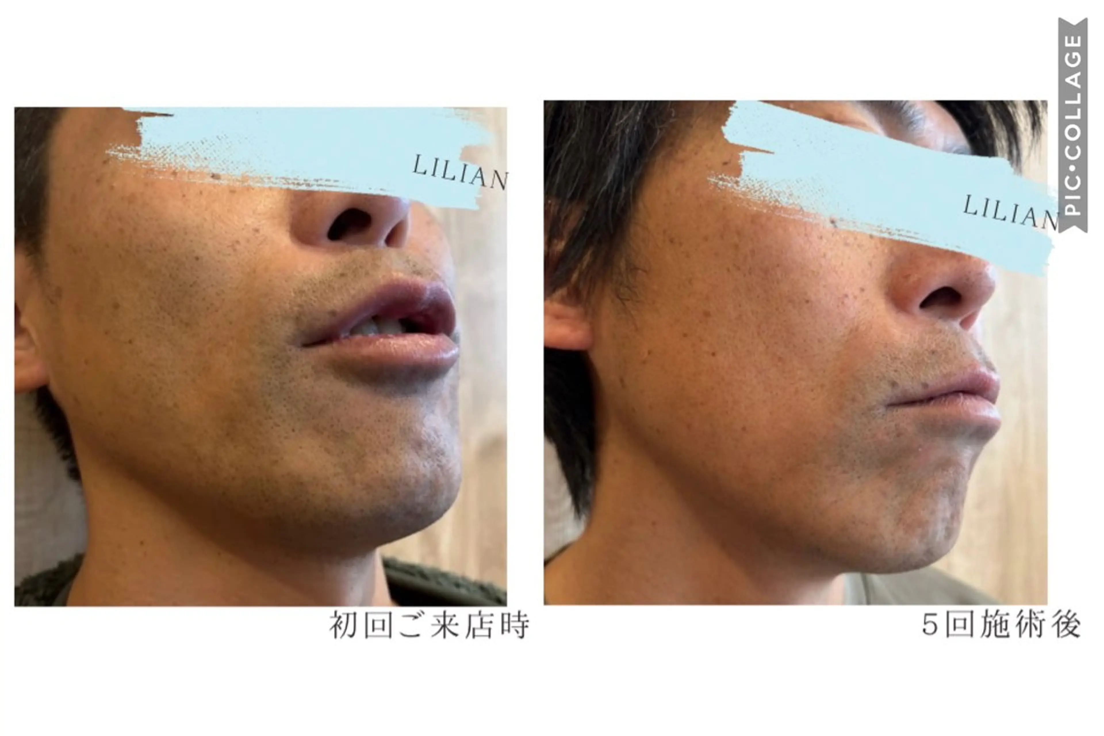 【men'sメニュー】お試し　ヒゲ脱毛　2回分の写真