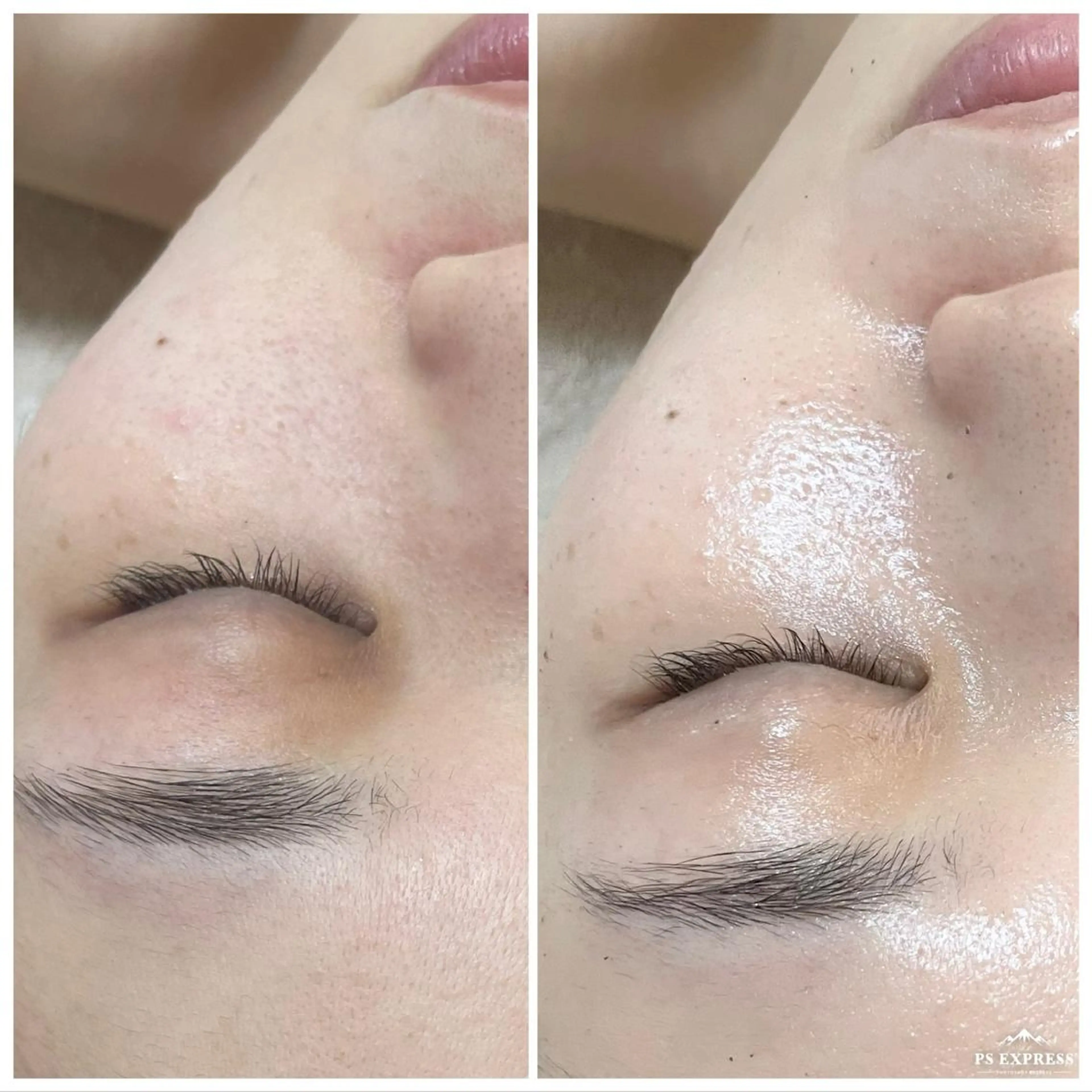 マツエク・マツパ エステ ニキビ・毛穴改善 🌿ハーブピーリングのエステ・リラクイメージ