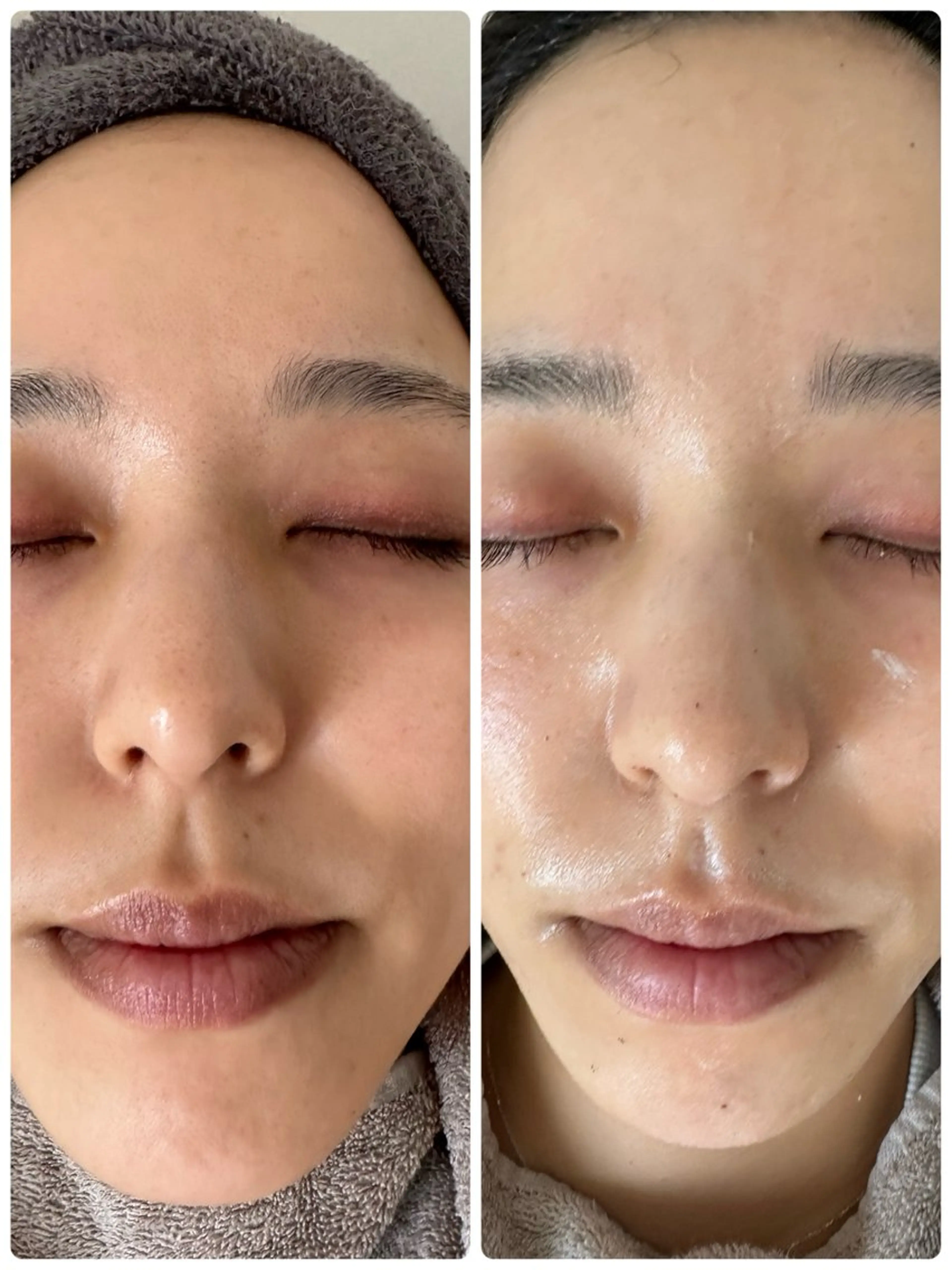 【REVI】陶肌トリートメント【剥離なしハーブピーリング】の写真