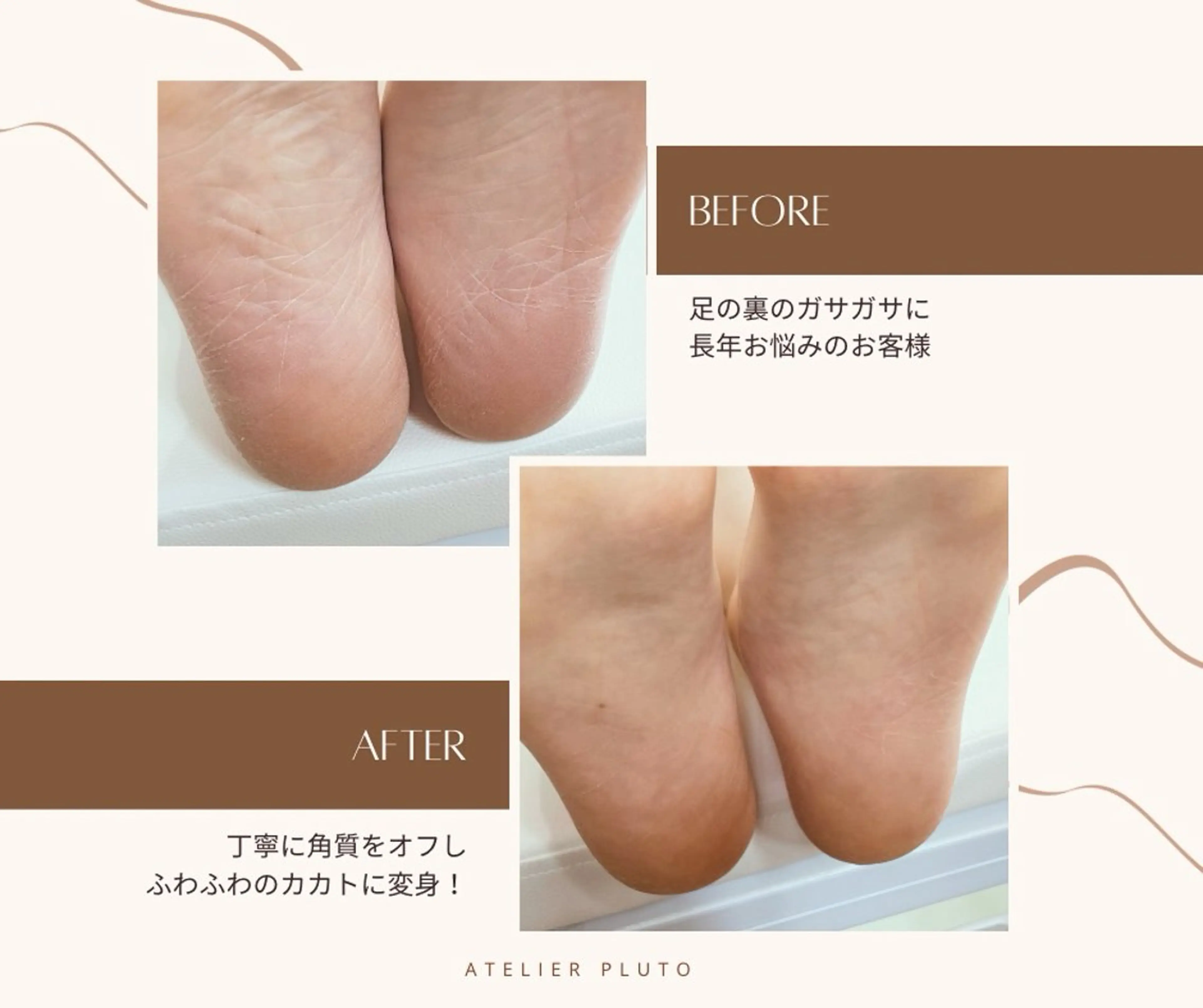 気になるガサガサ⚡️赤ちゃんみたいな足裏に👼フット足裏角質ケア＆爪周り角質ケア🦶の写真