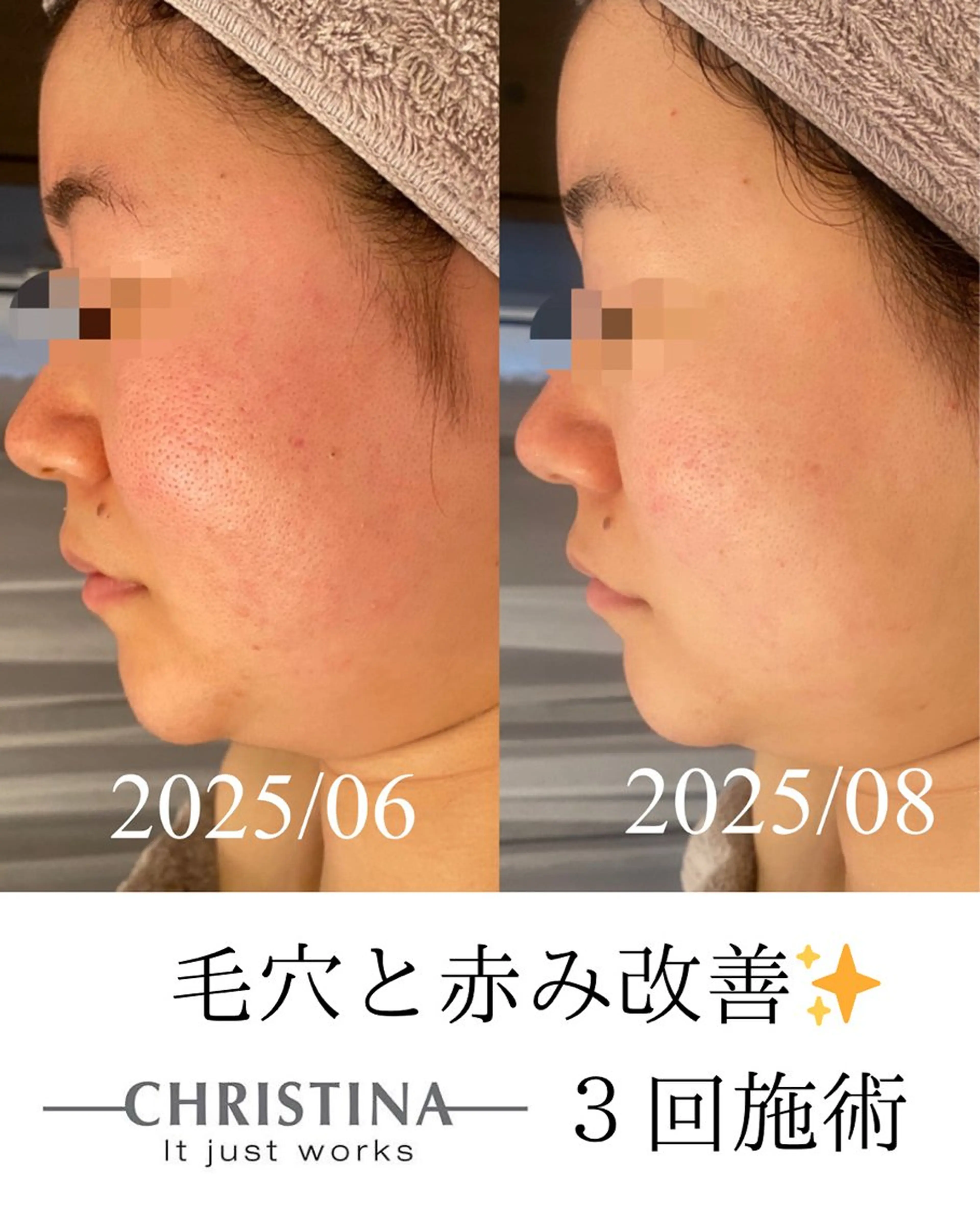 エステ リラク 田中For..天王寺 肌質改善/よもぎ蒸しのエステ・リラクイメージ