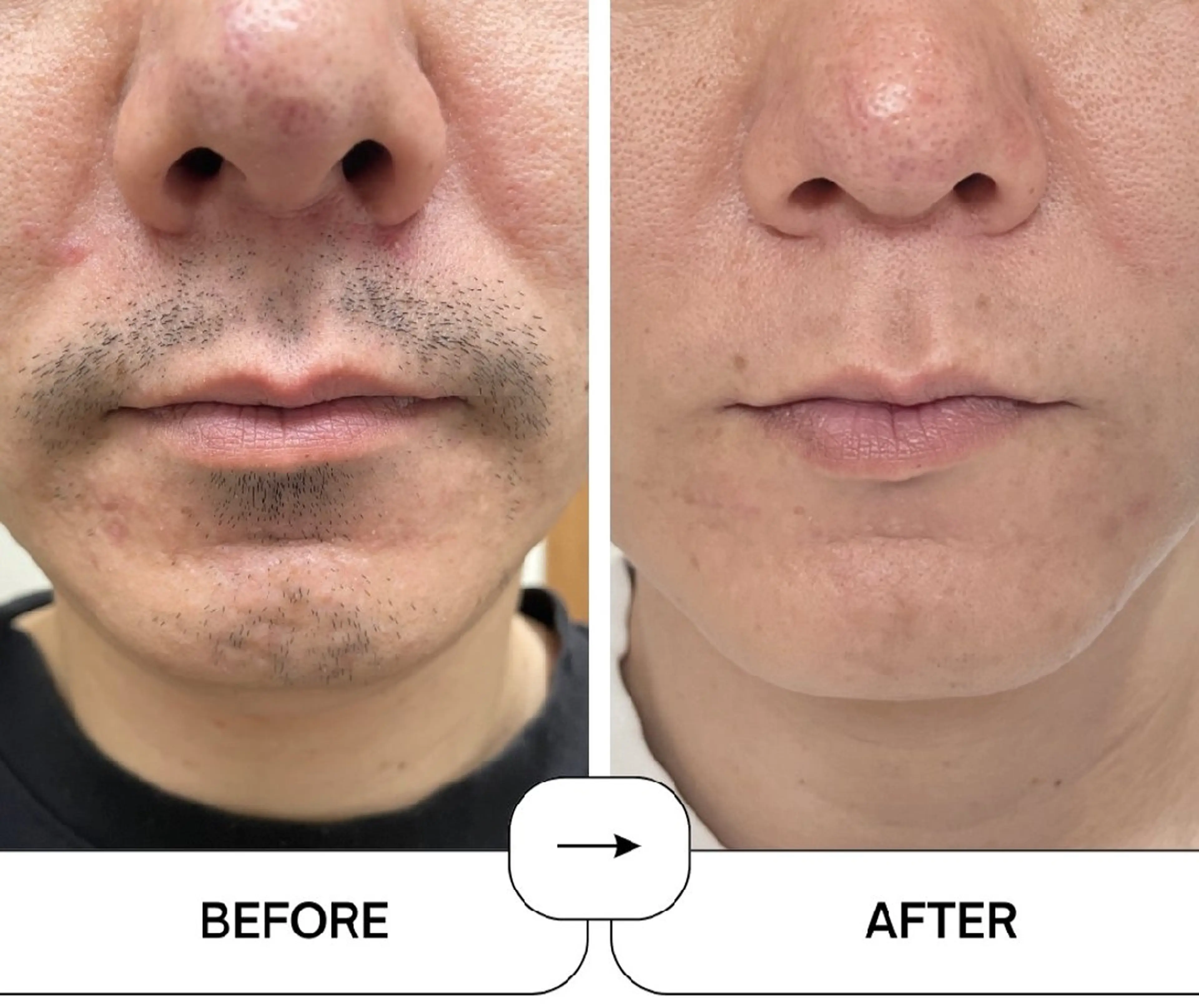 ヒゲ脱毛、vio以外受け付けてます！の写真