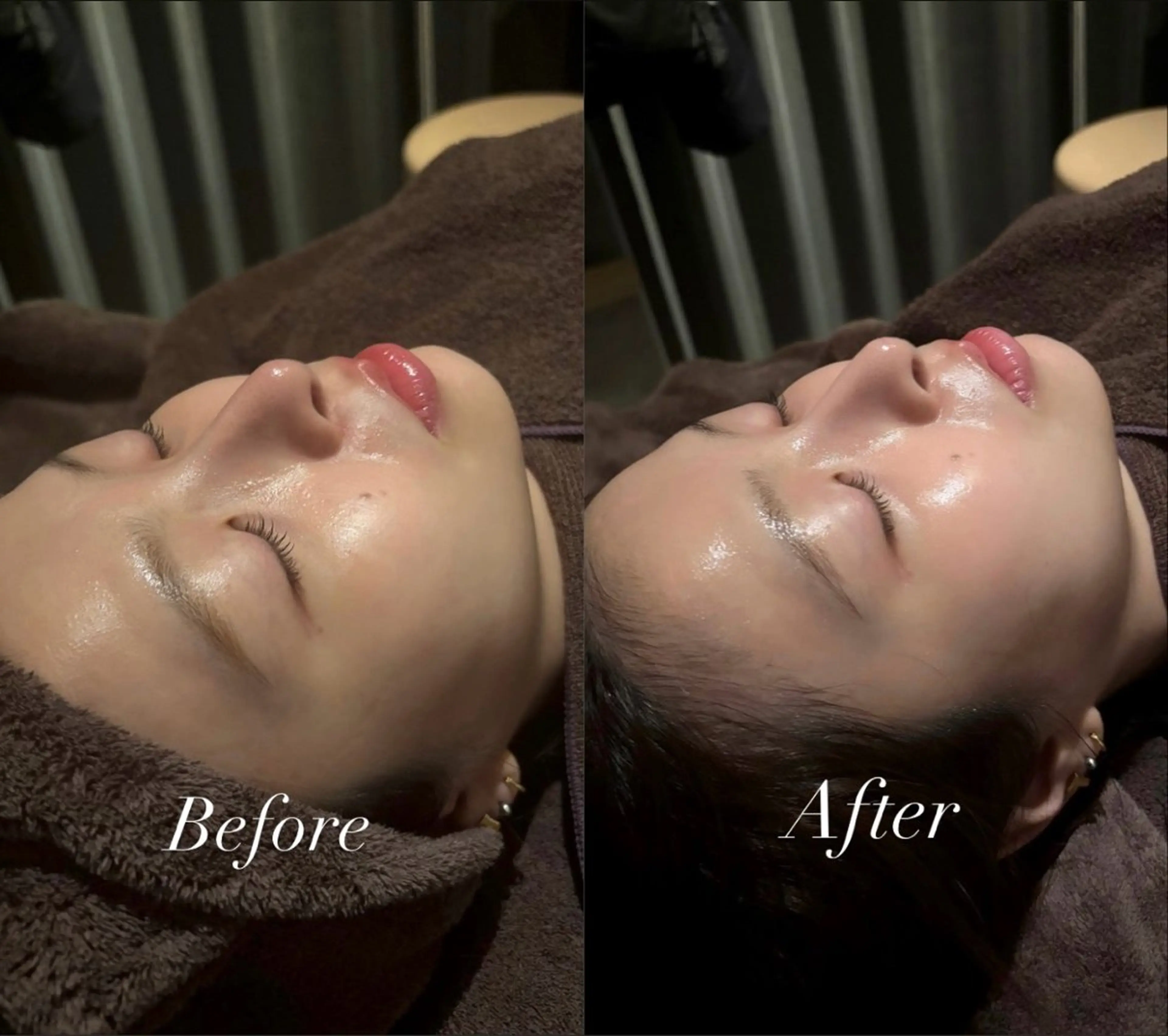 【💎人気No.1💎】毛穴レス美肌を今すぐ体験✨️【シンデレラピーリング】韓国水光肌｜毛穴ピーリング🌱9800円💖の写真