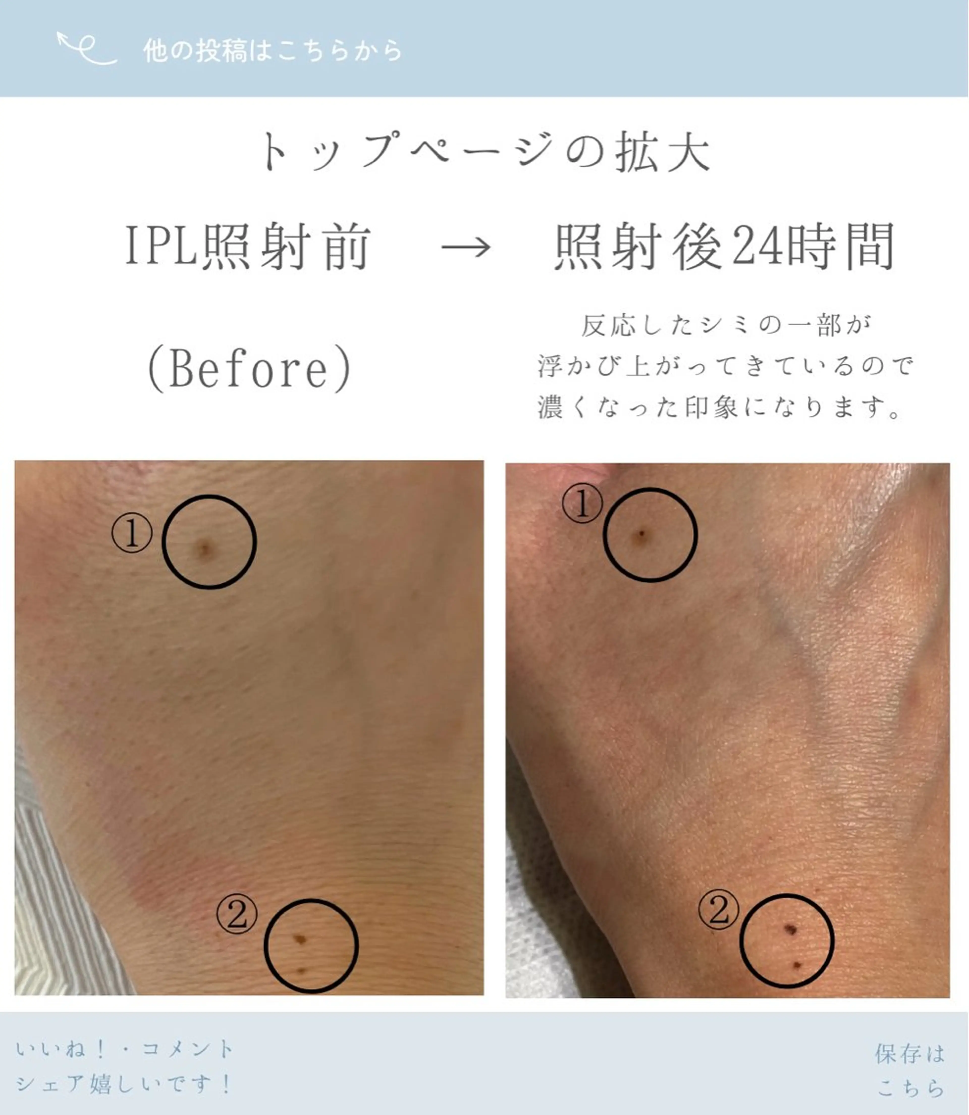 くすみ・シミ改善/ ララピール/光フォトのその他イメージ