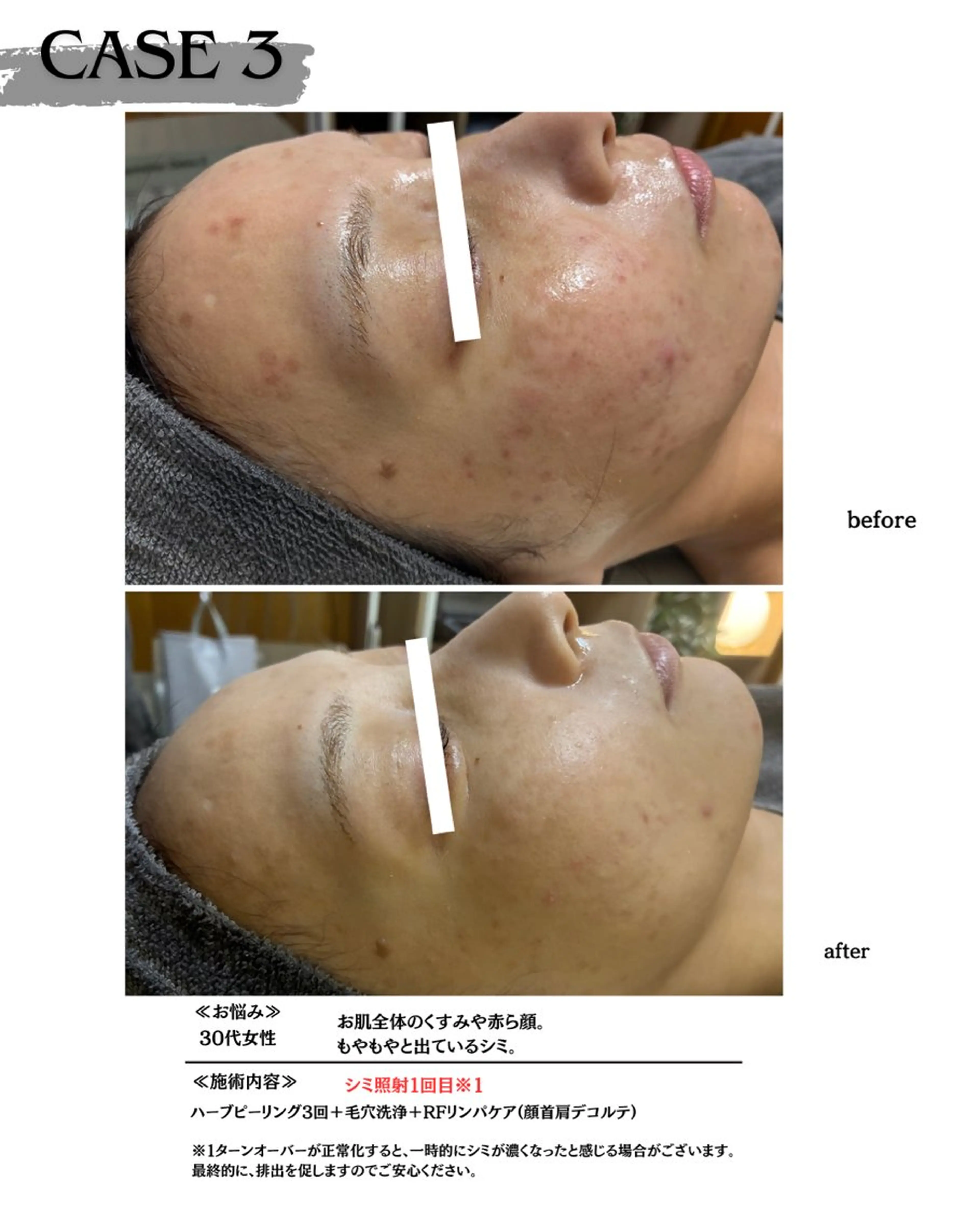 エステ 素肌育成・シミケア専門サロン美潤-miulu-所属・【医療提携サロン】 【シミケア専門】のエステ・リラクイメージ