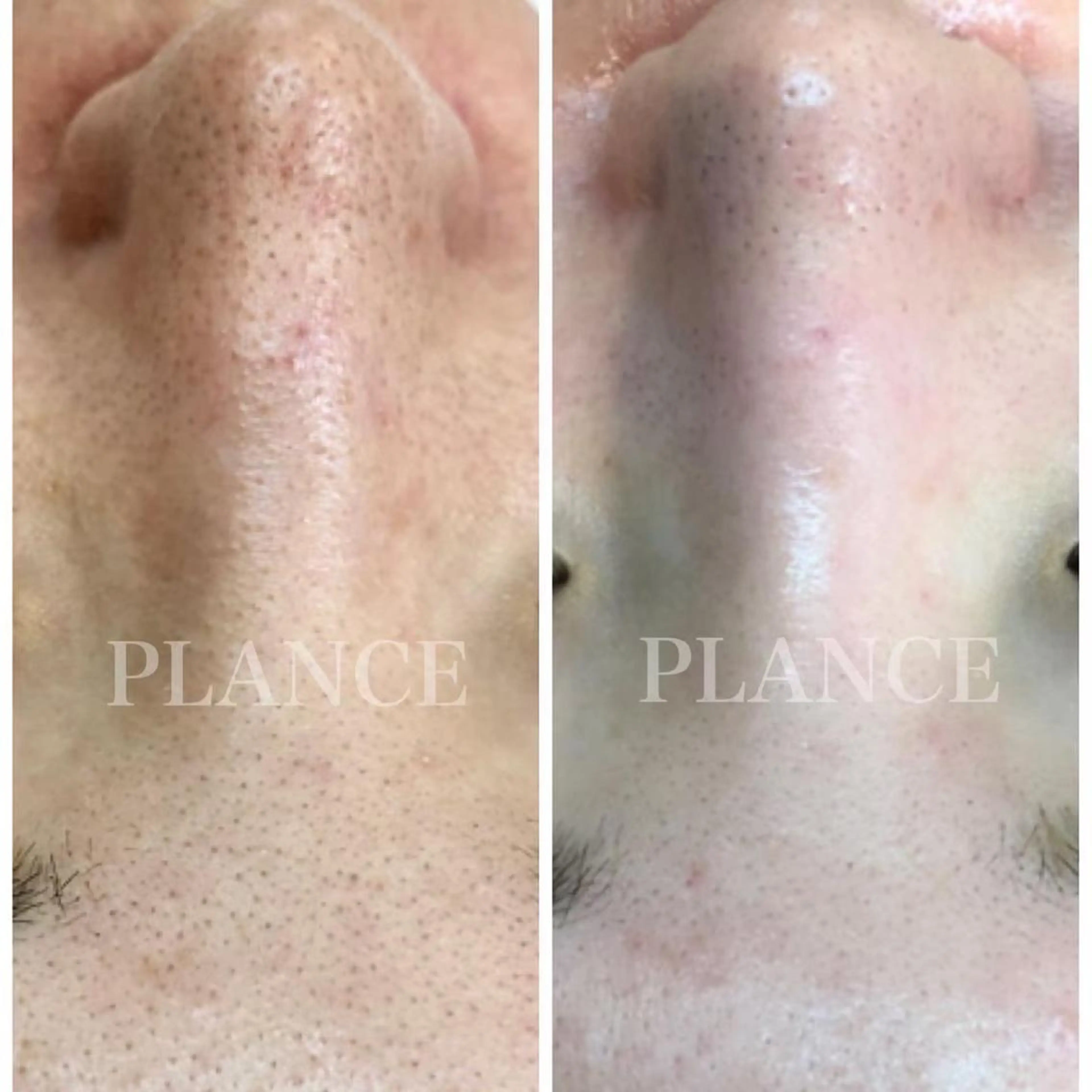 エステ フェイシャル専門 肌質改善/プランスのエステ・リラクイメージ