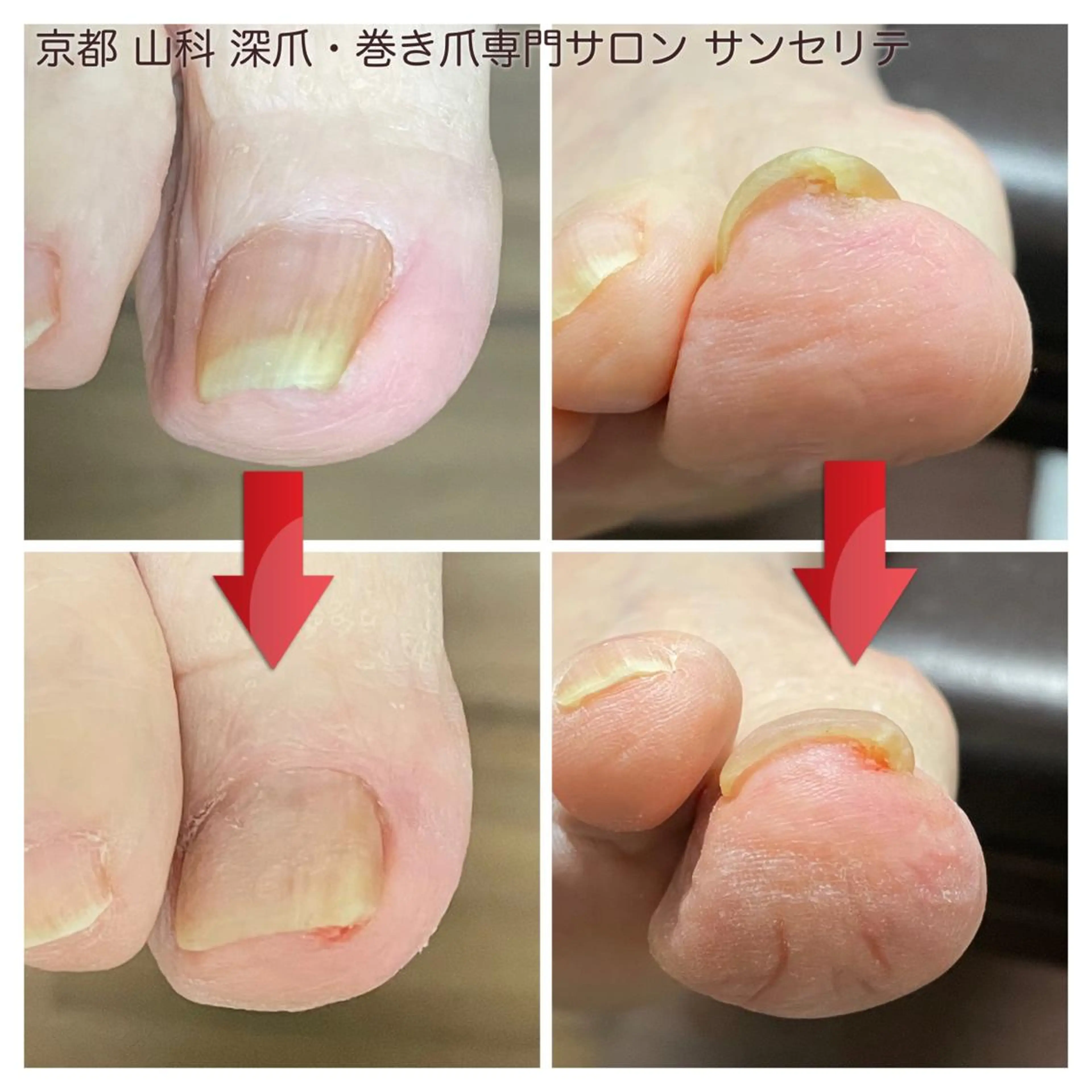 ネイル 深爪・巻き爪 専門サンセリテのネイルデザイン