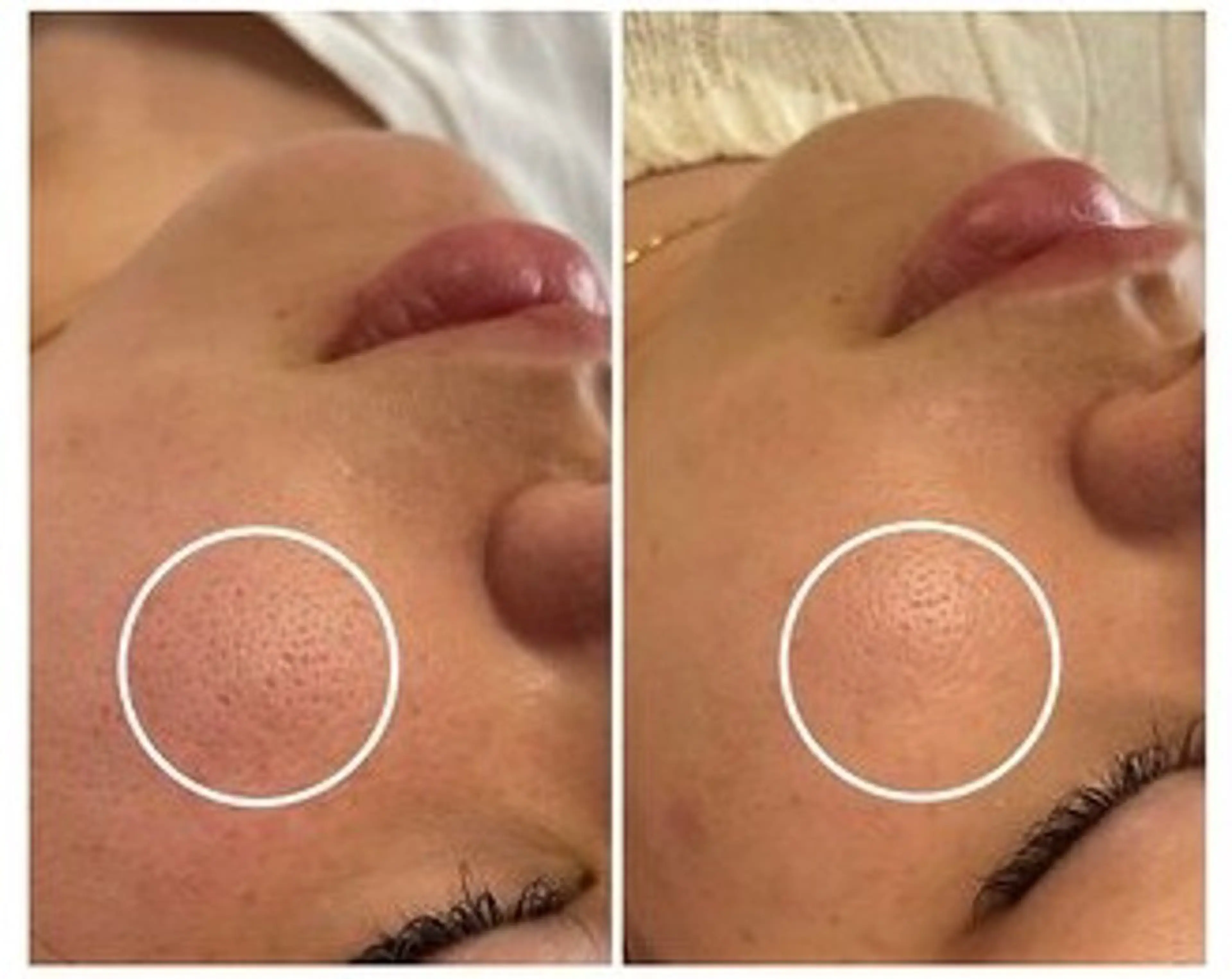 エイジングケアサロンBIOEL所属・肌質改善BIOELプ ラズマ/ラミピールのエステ・リラクイメージ