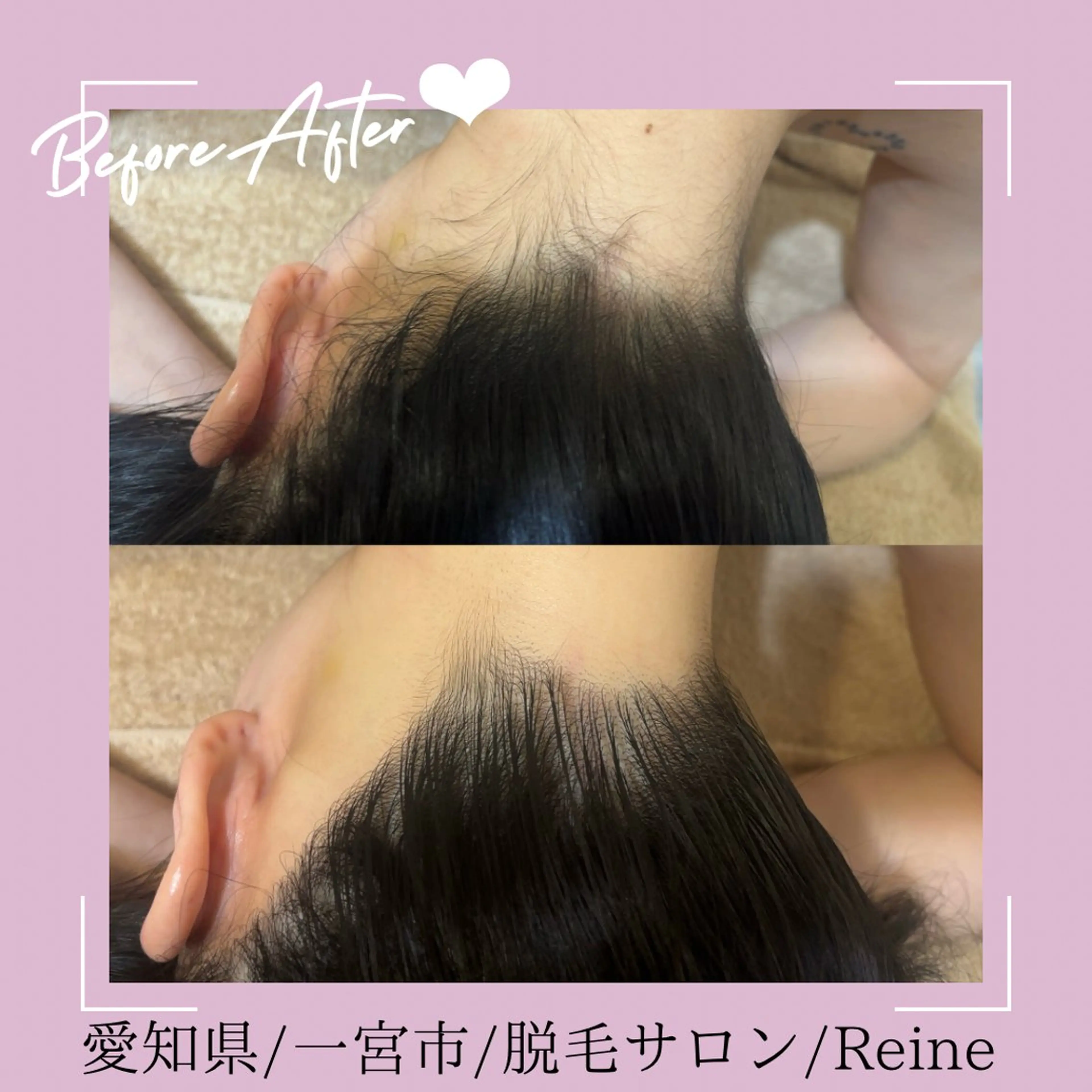脱毛 Reine BeautySalon所属・毛穴/シミ肝斑/脱毛 横山梨里のエステ・リラクイメージ