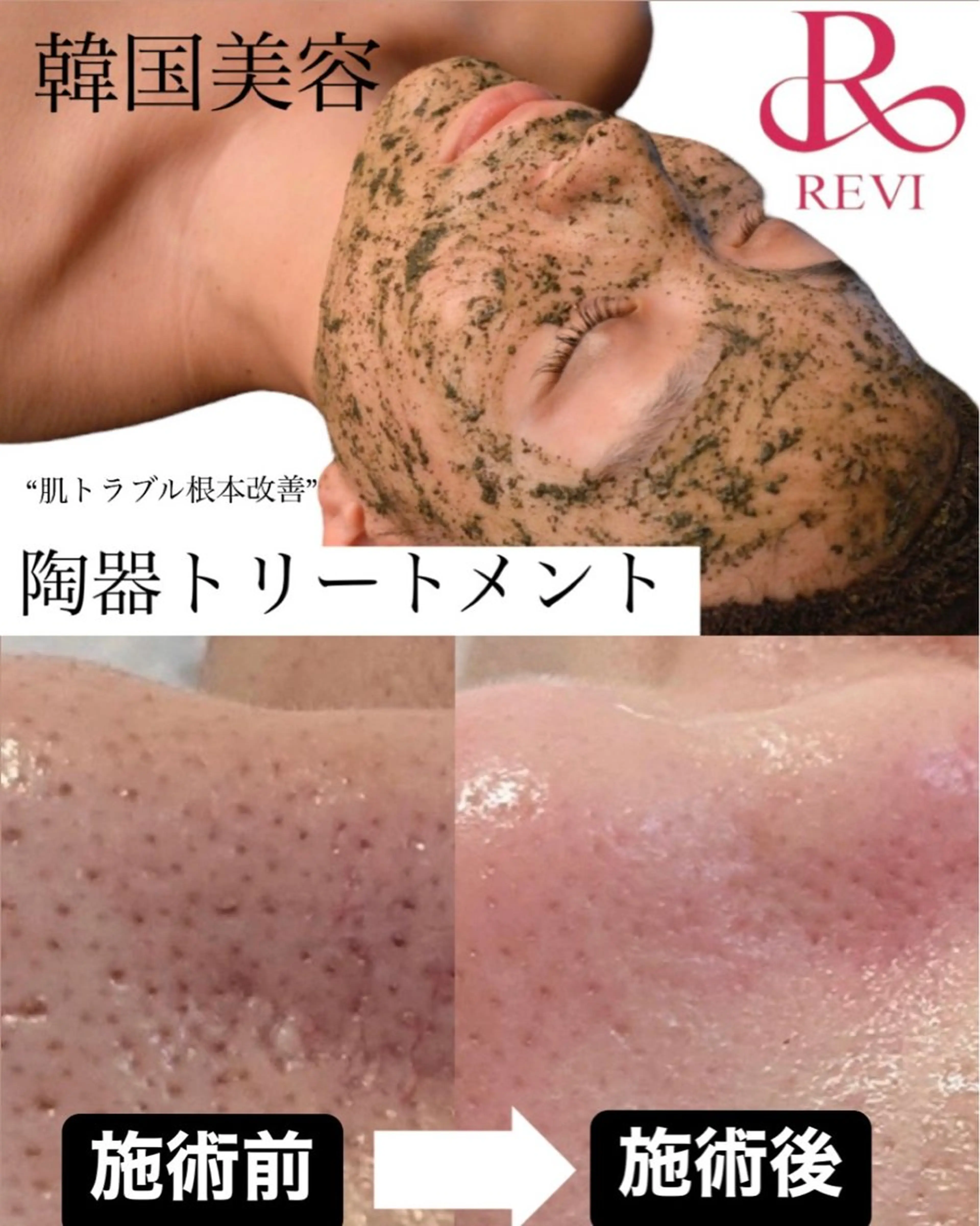 韓国肌管理Cocoh ハーブピーリングのエステ・リラクイメージ