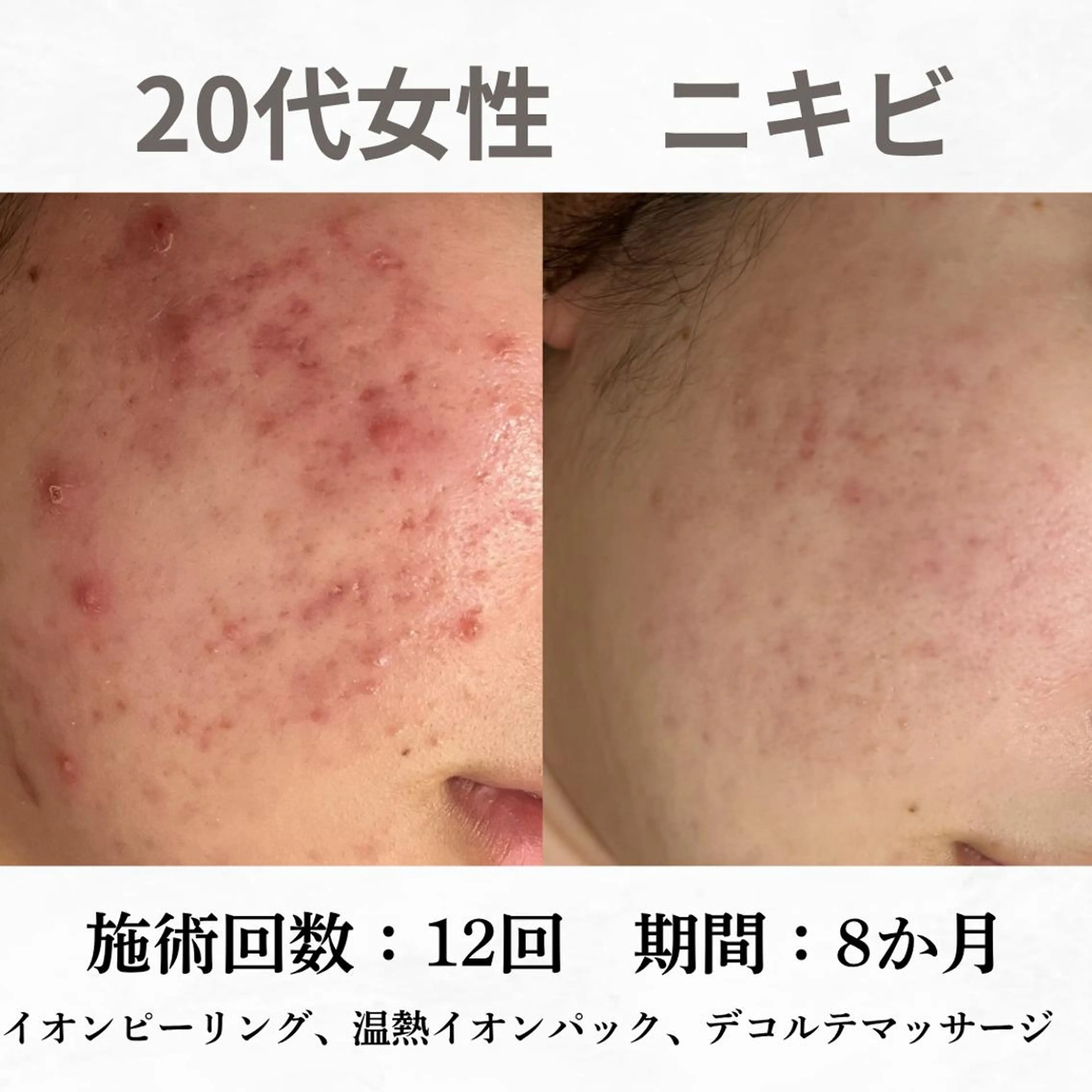 重度ニキビ専門🌷 ダウンタイムなしのエステ・リラクイメージ