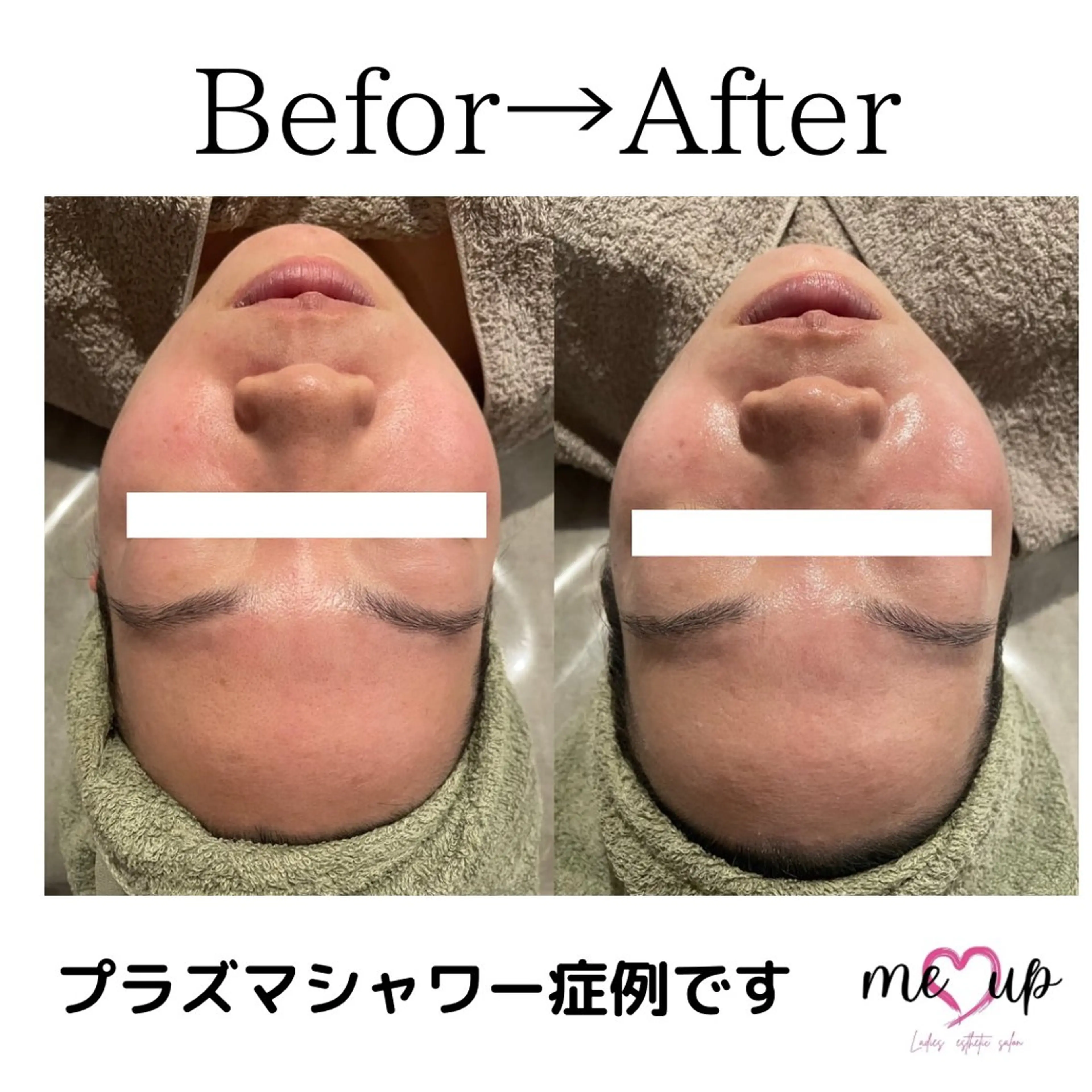 Meupニキビ専門店 背中/ハーブ/肌管理のその他イメージ