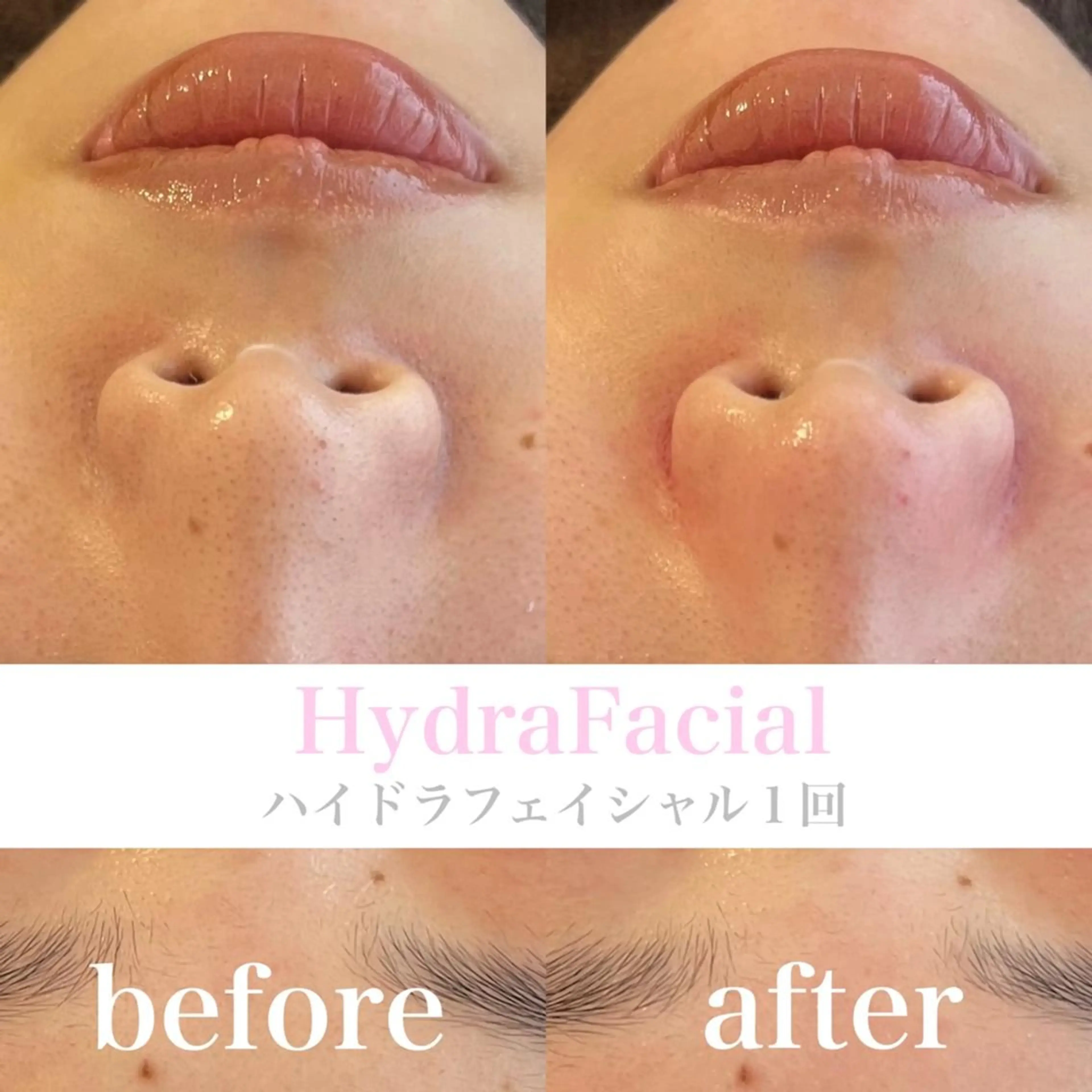 ニキビ対策＆いちご鼻撲滅Menu🍓毛穴洗浄+幹細胞パックの写真