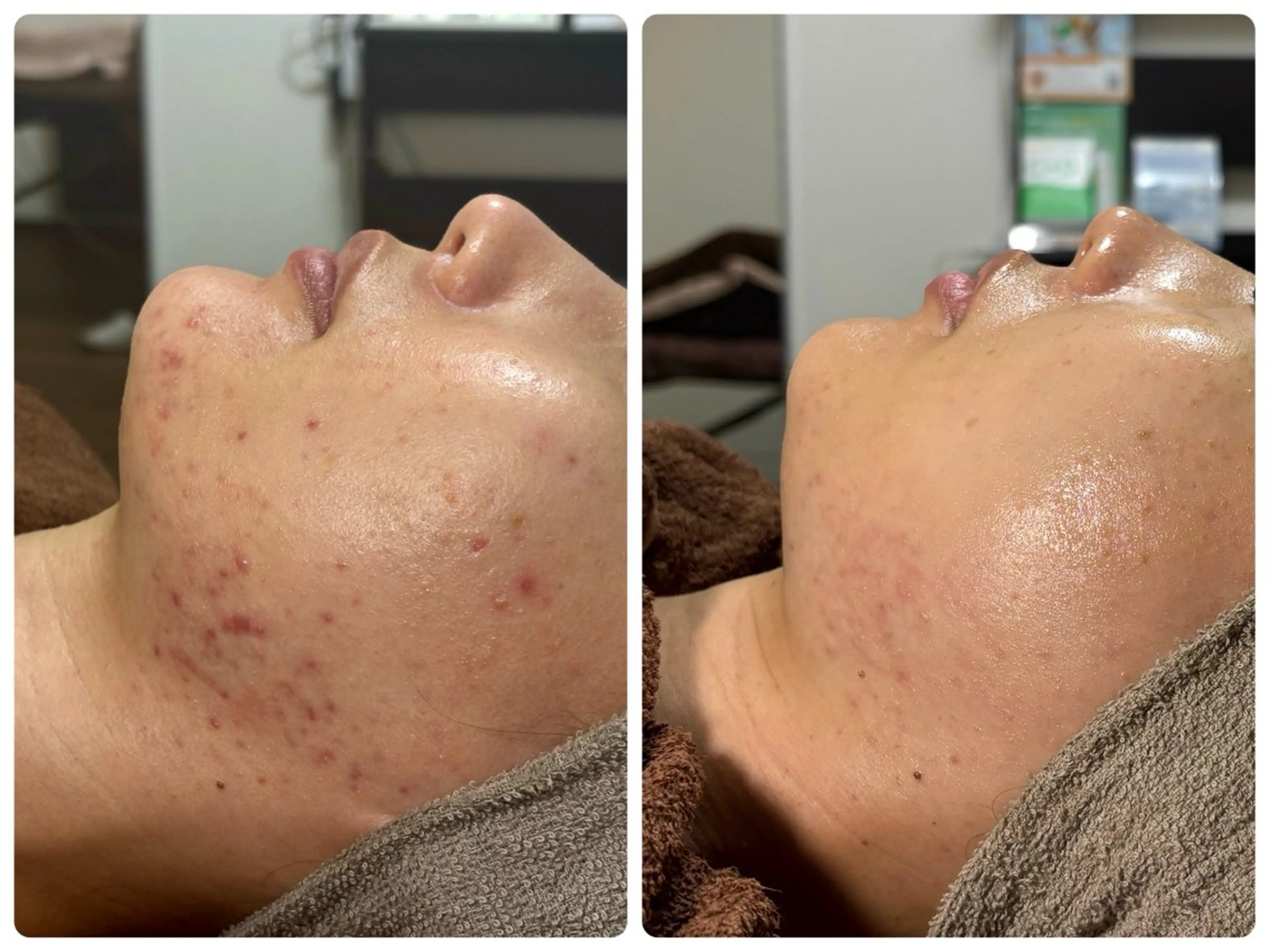 エステ 小顔ハーブピーリング 美容鍼/毛穴洗浄のエステ・リラクイメージ