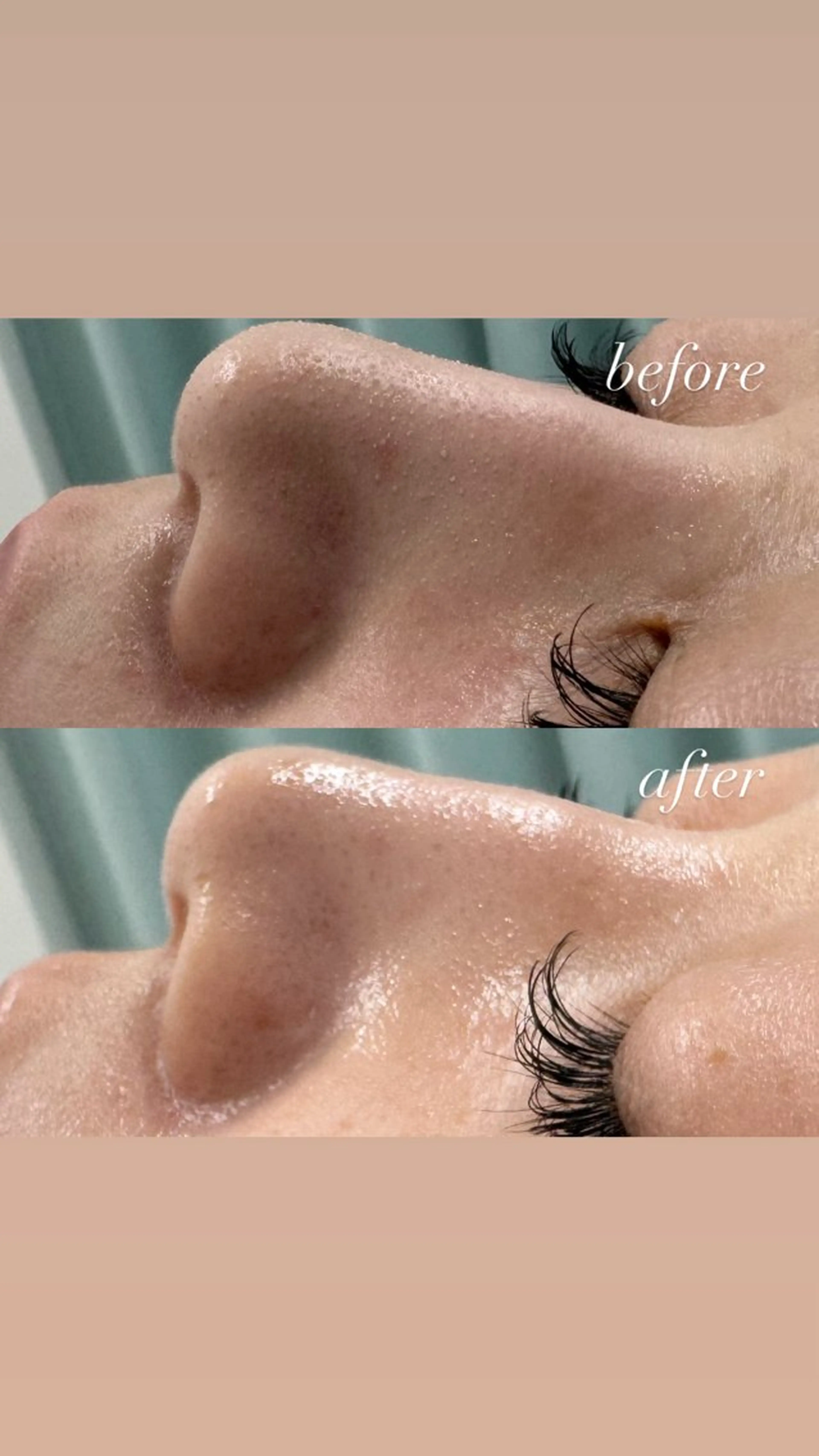 【水光肌パック仕上げ】💎（保湿・菌活）１回の写真