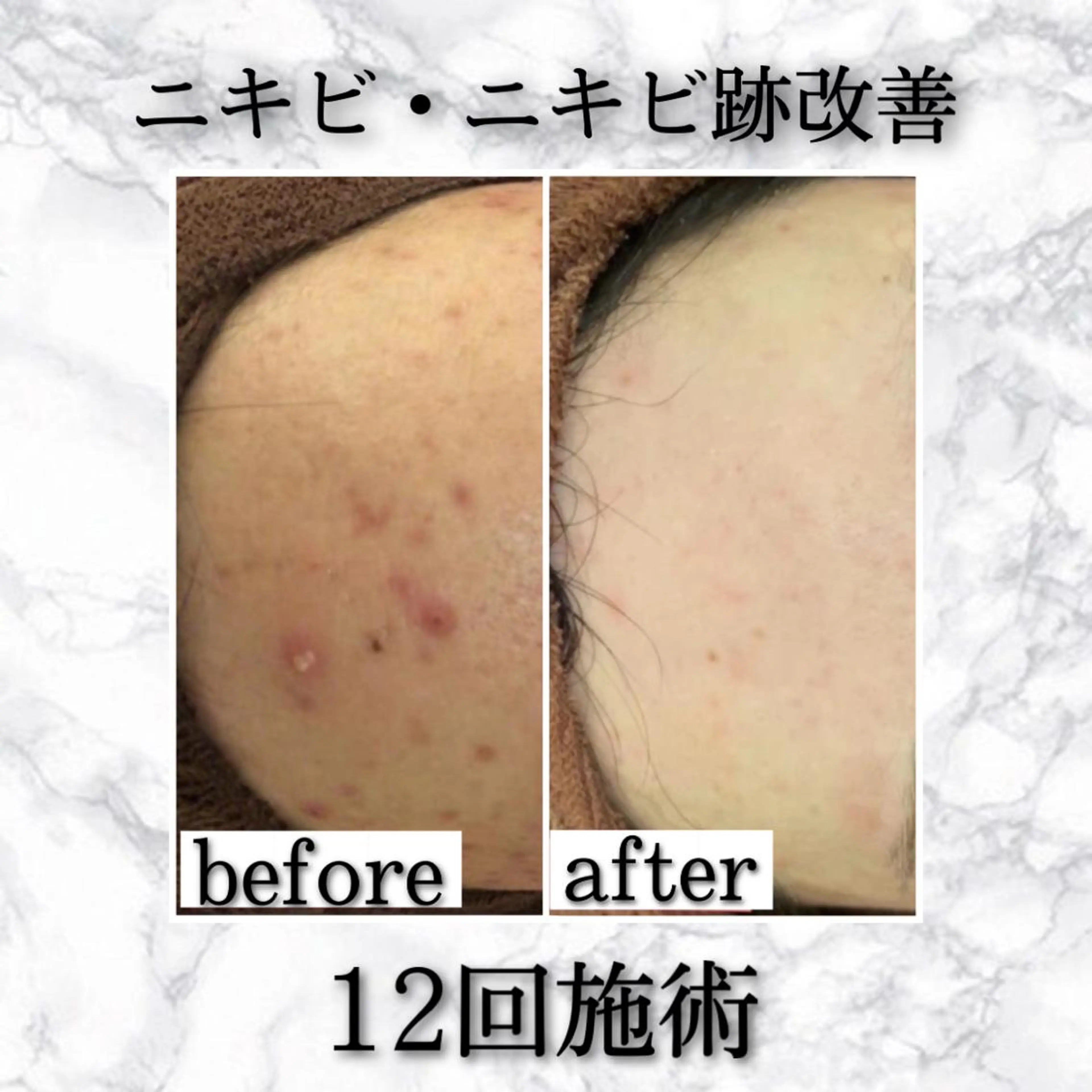 セミロング カラー パーマ ヘアアレンジ メンズ キッズ ネイル マツエク・マツパ アイブロウ エステ リラク ニキビ特化型エステ 🍓最短で肌質改善のエステ・リラクイメージ