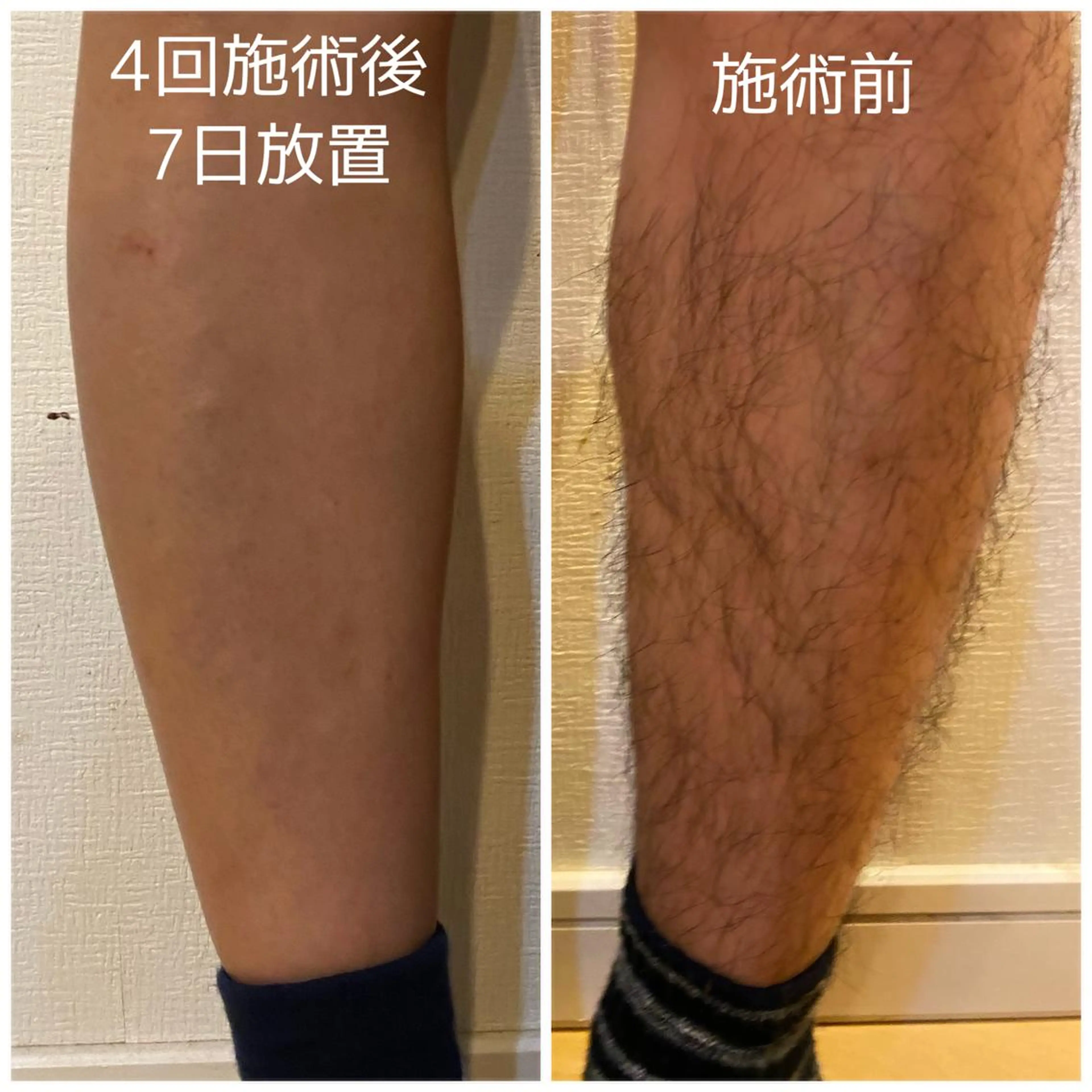 男性 両ひざ下脱毛 安い  ¥8000の写真