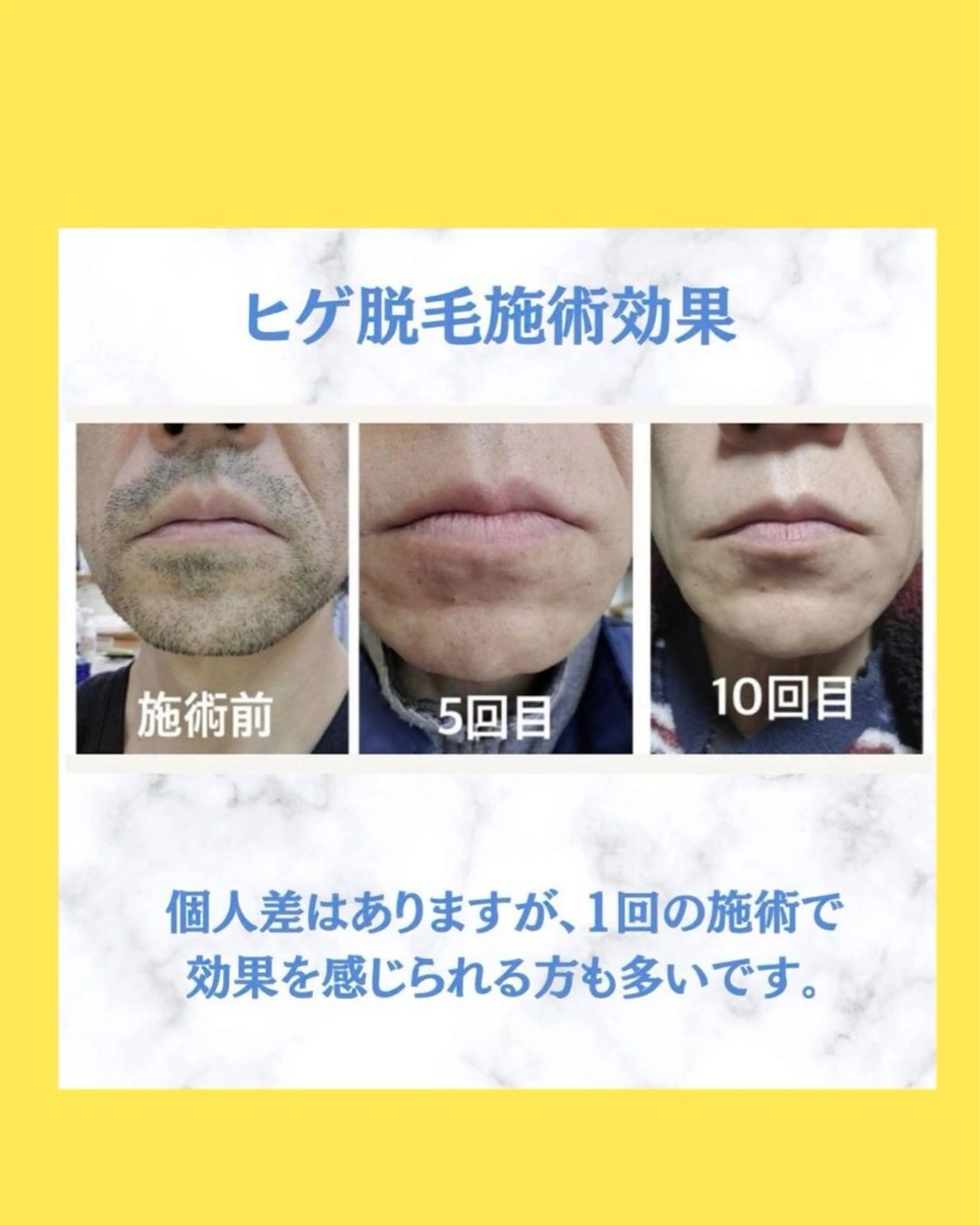 ヘアサロンLISALISA所属・セルフ脱毛・光エステ LISALISAのエステ・リラクイメージ