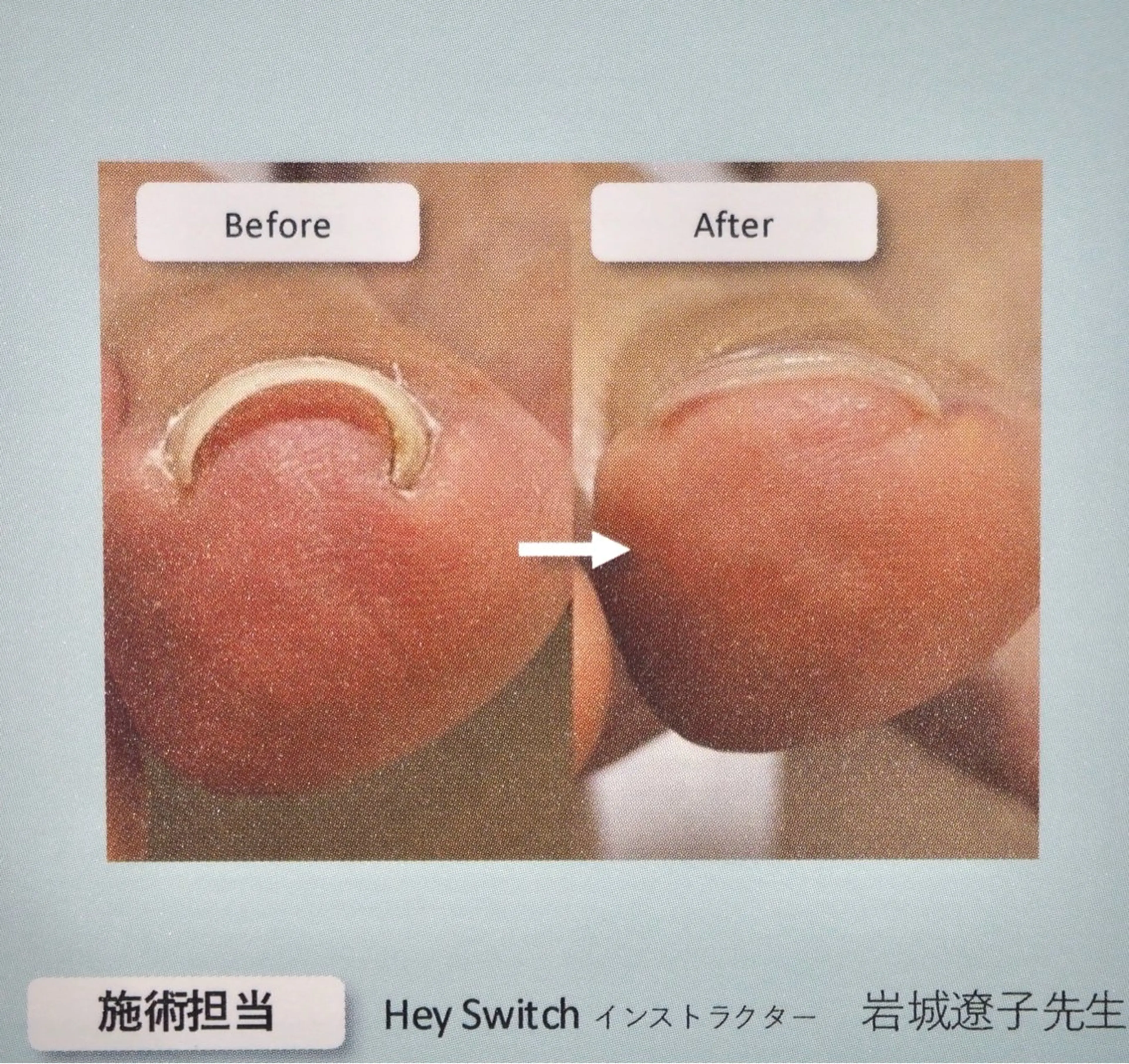 【ｆｏｏｔ】Hey Switchジェル巻き爪ケアの写真