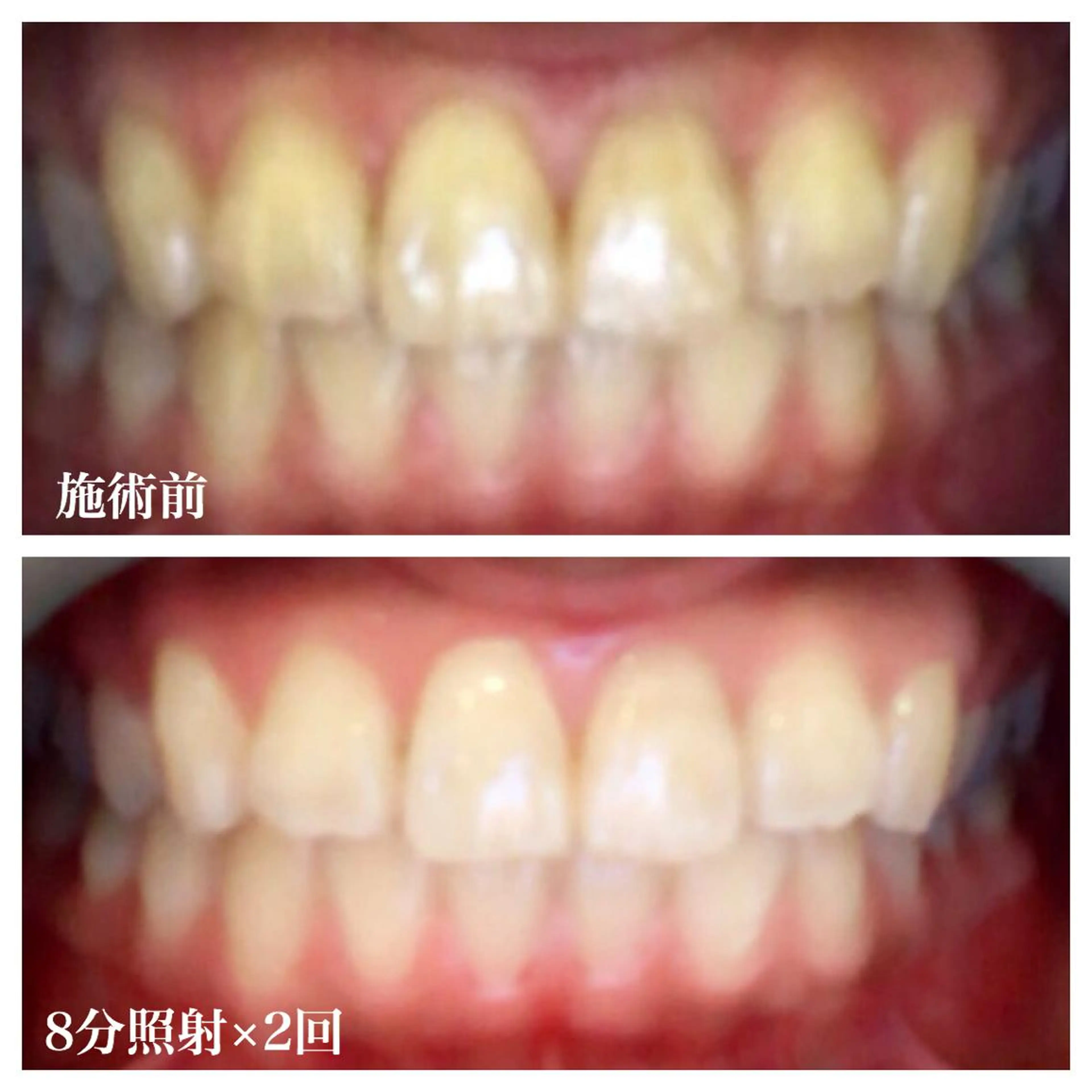 ネイル/耳つぼ /新ホワイトニングのネイルデザイン