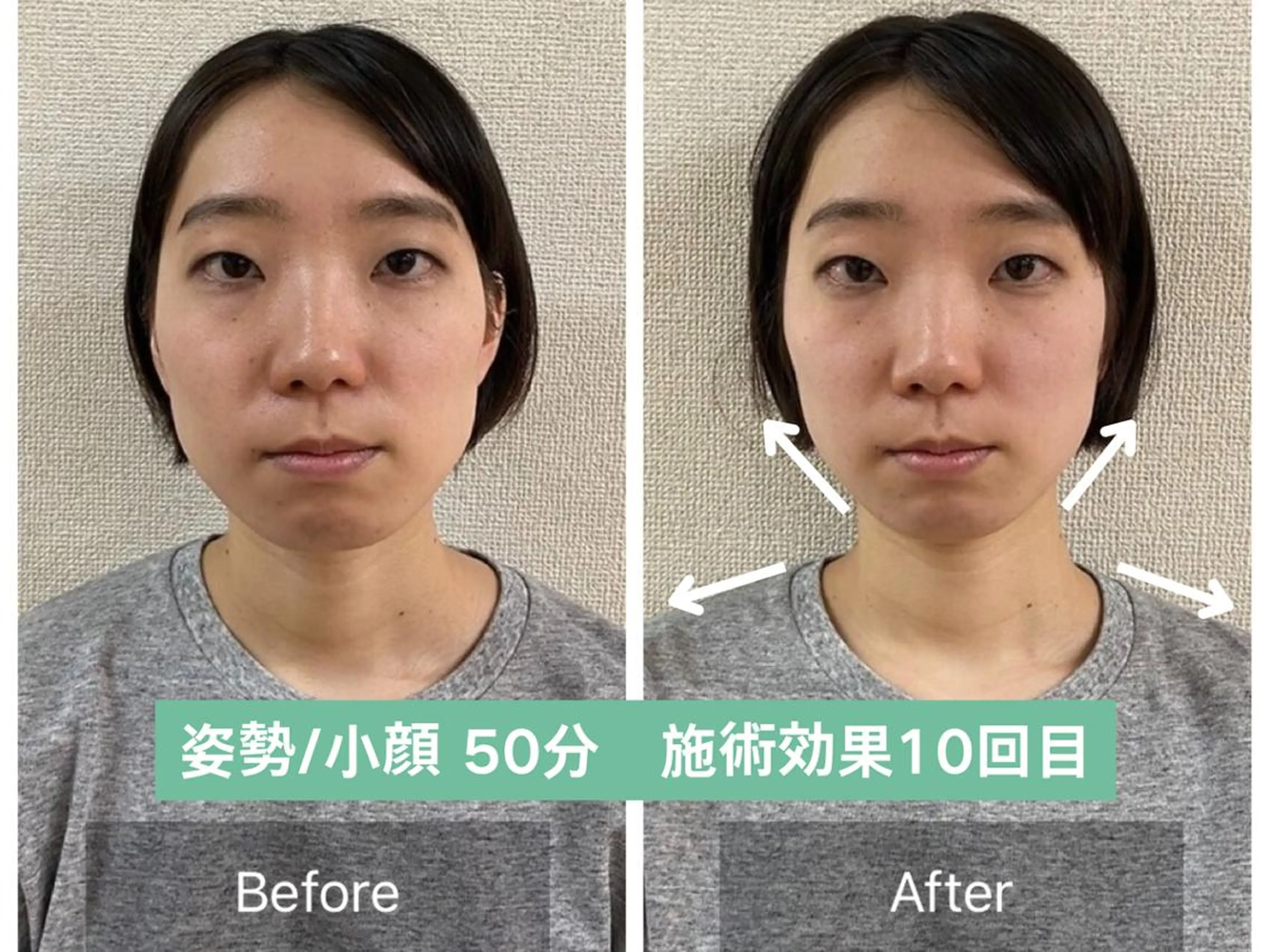 顔のたるみ・左右差/姿勢調整の写真