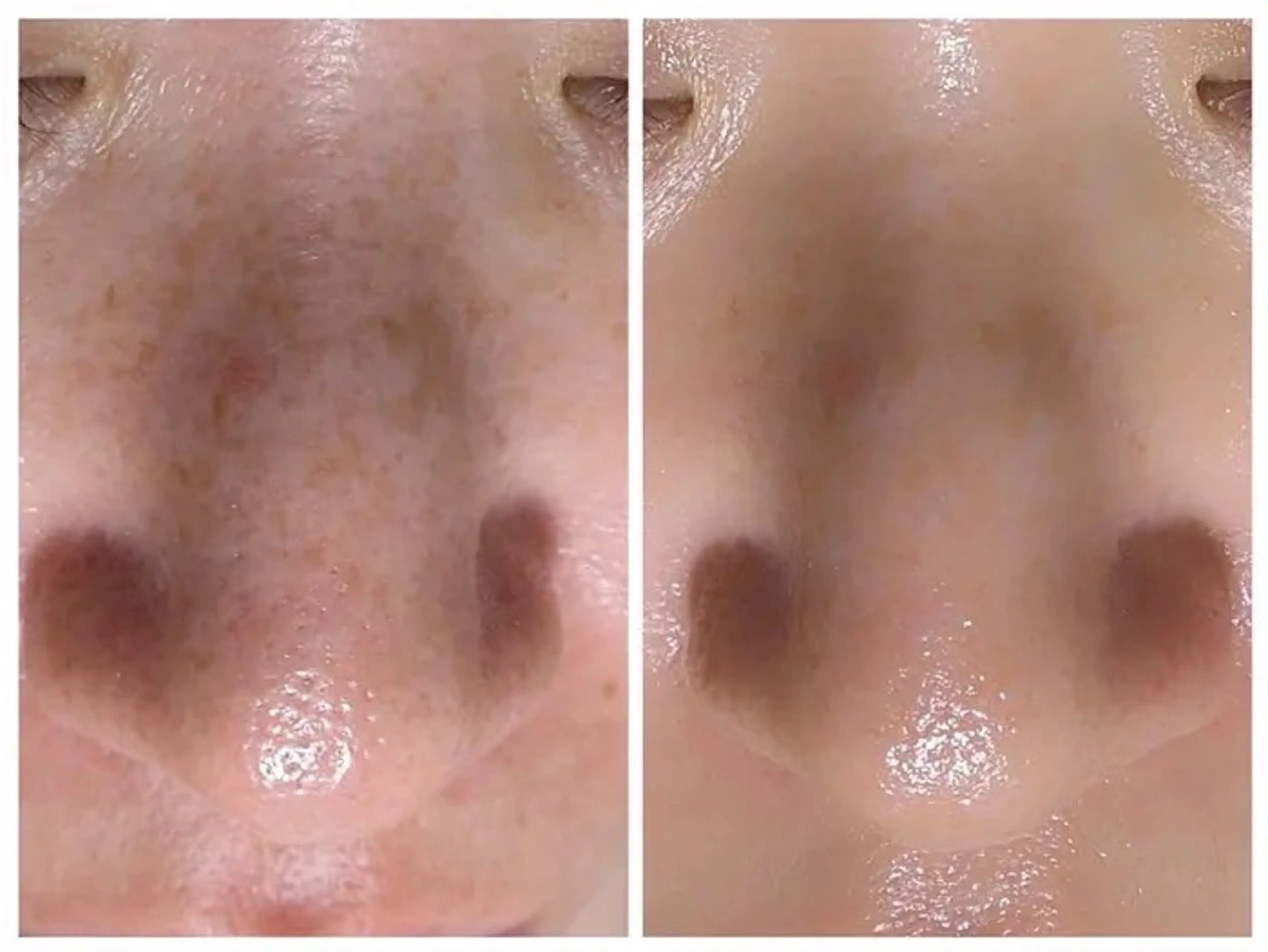 【人気Ｎｏ．1毛穴大洗浄ケア】黒ずみ除去＋小顔造形リンパエステ60分¥3000の写真