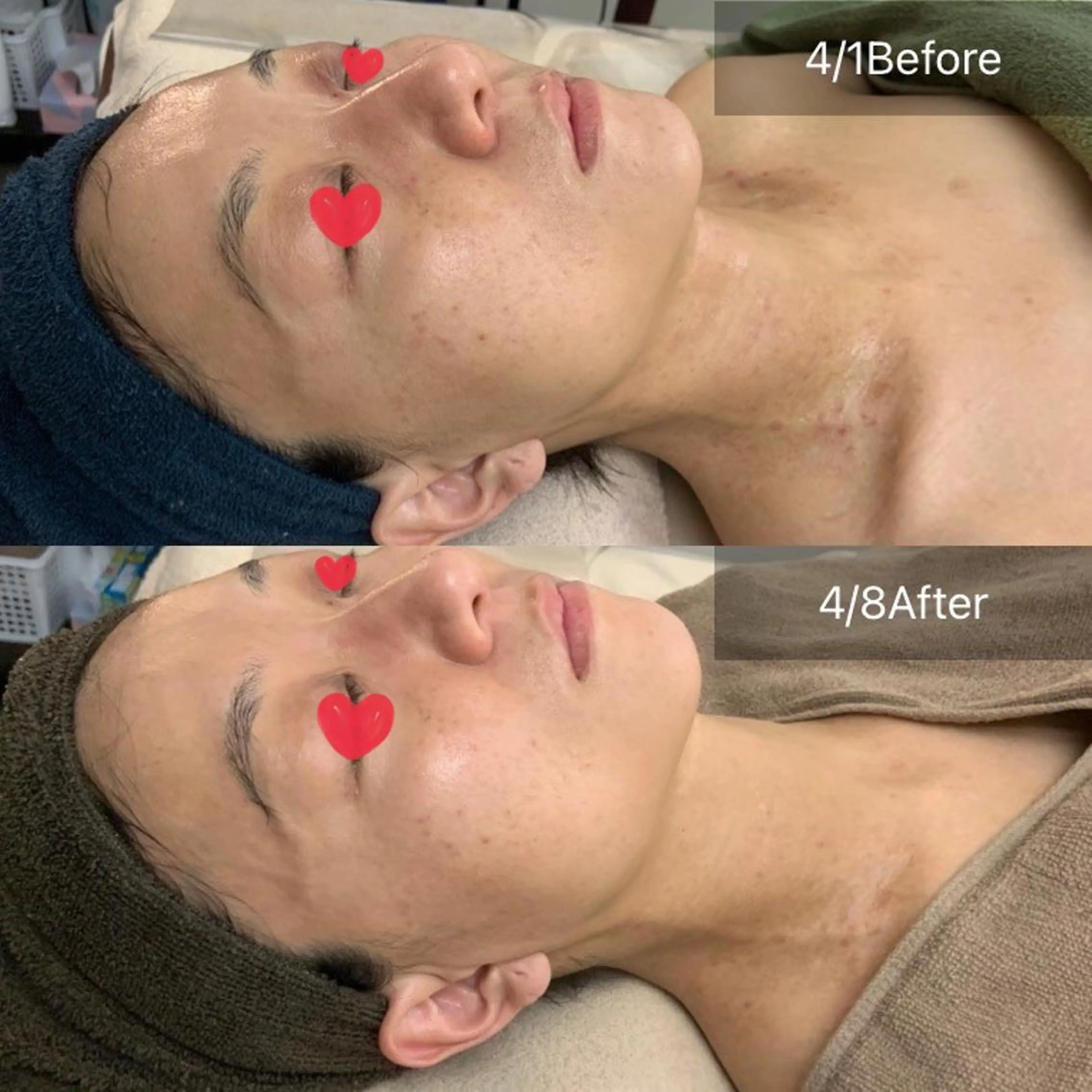 人気No.1【毛穴開き/加齢肌/たるみ/シミ/ミニ体験の8倍ハーブ！】グリーンピールスペシャル体験　丁寧毛穴洗浄付の写真