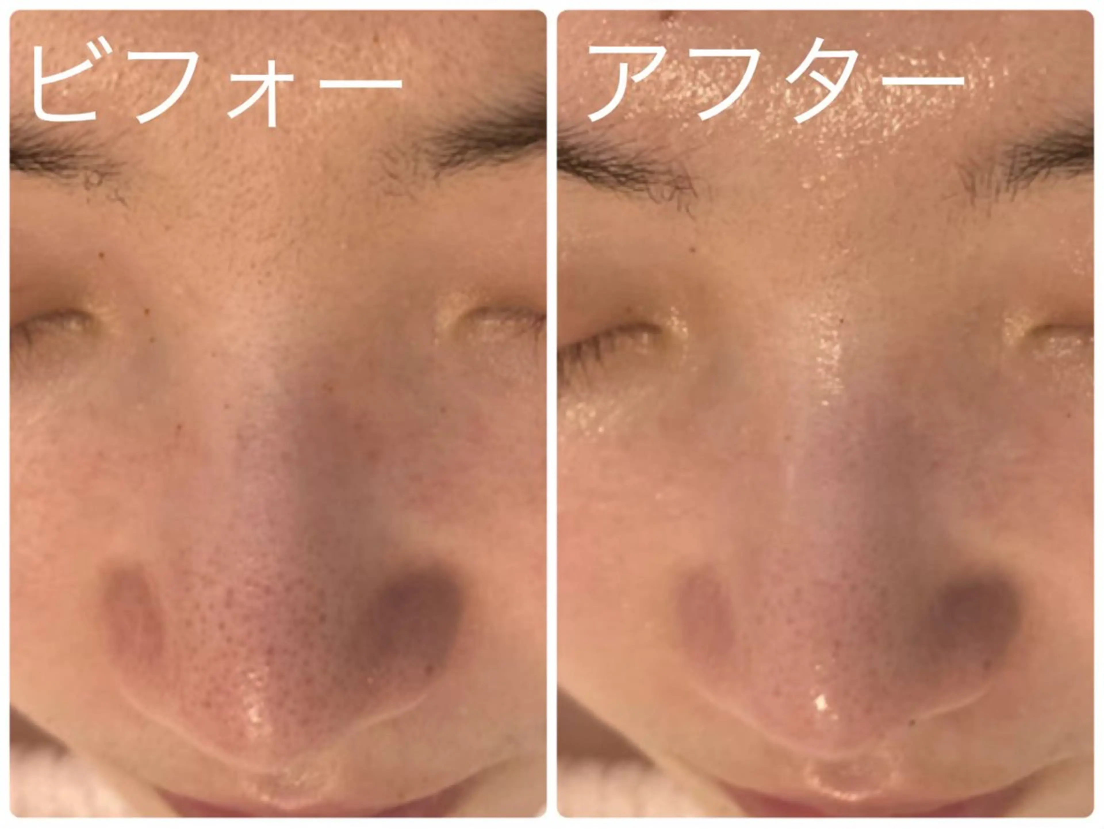 頑固な毛穴汚れに💭毛穴洗浄＆植物幹細胞パックの写真