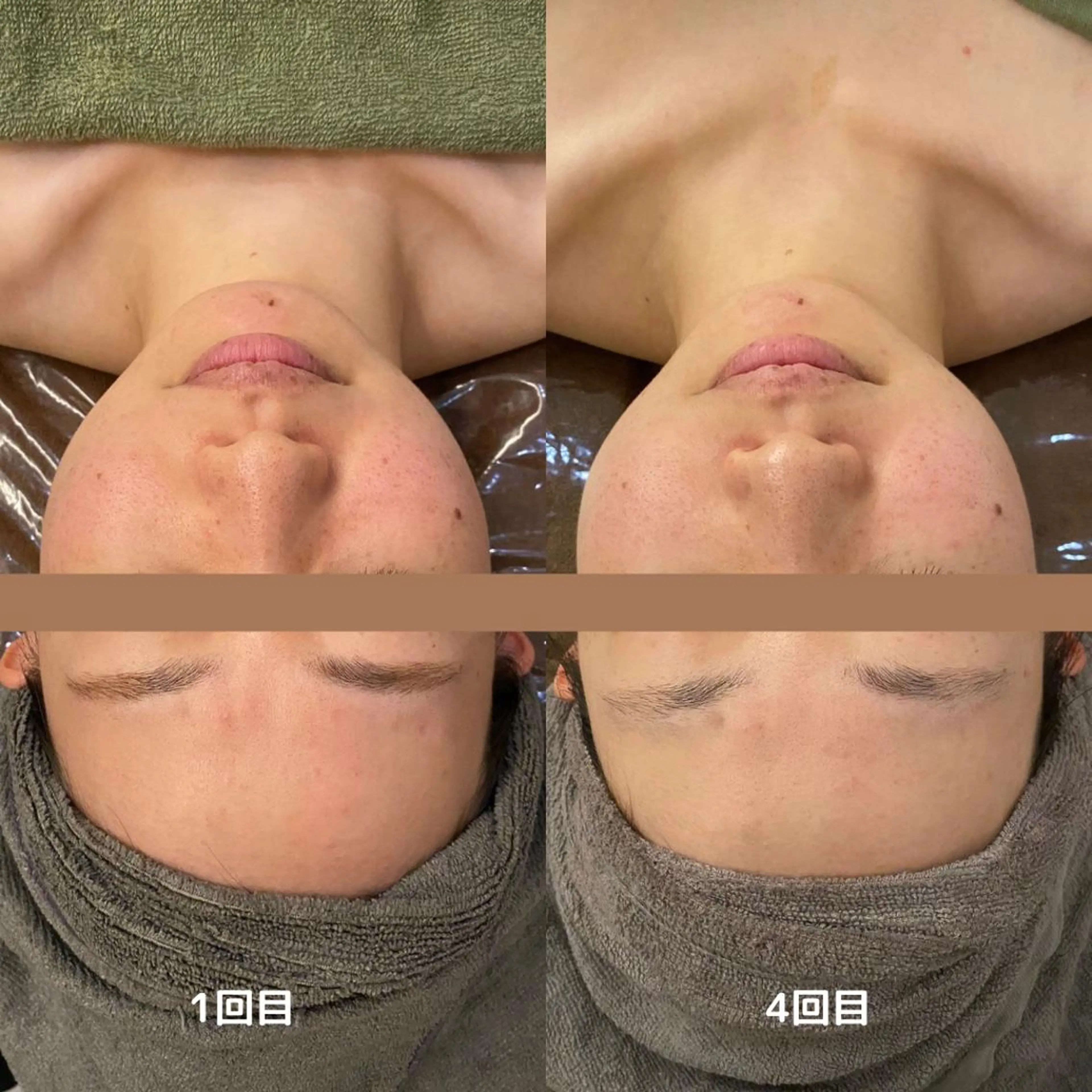 【ターンオーバーを促してお肌をリセット✨】バクテリウムピール🫧 45分【あの頃のお肌を手に入れる!敏感肌の方にも◎】の写真