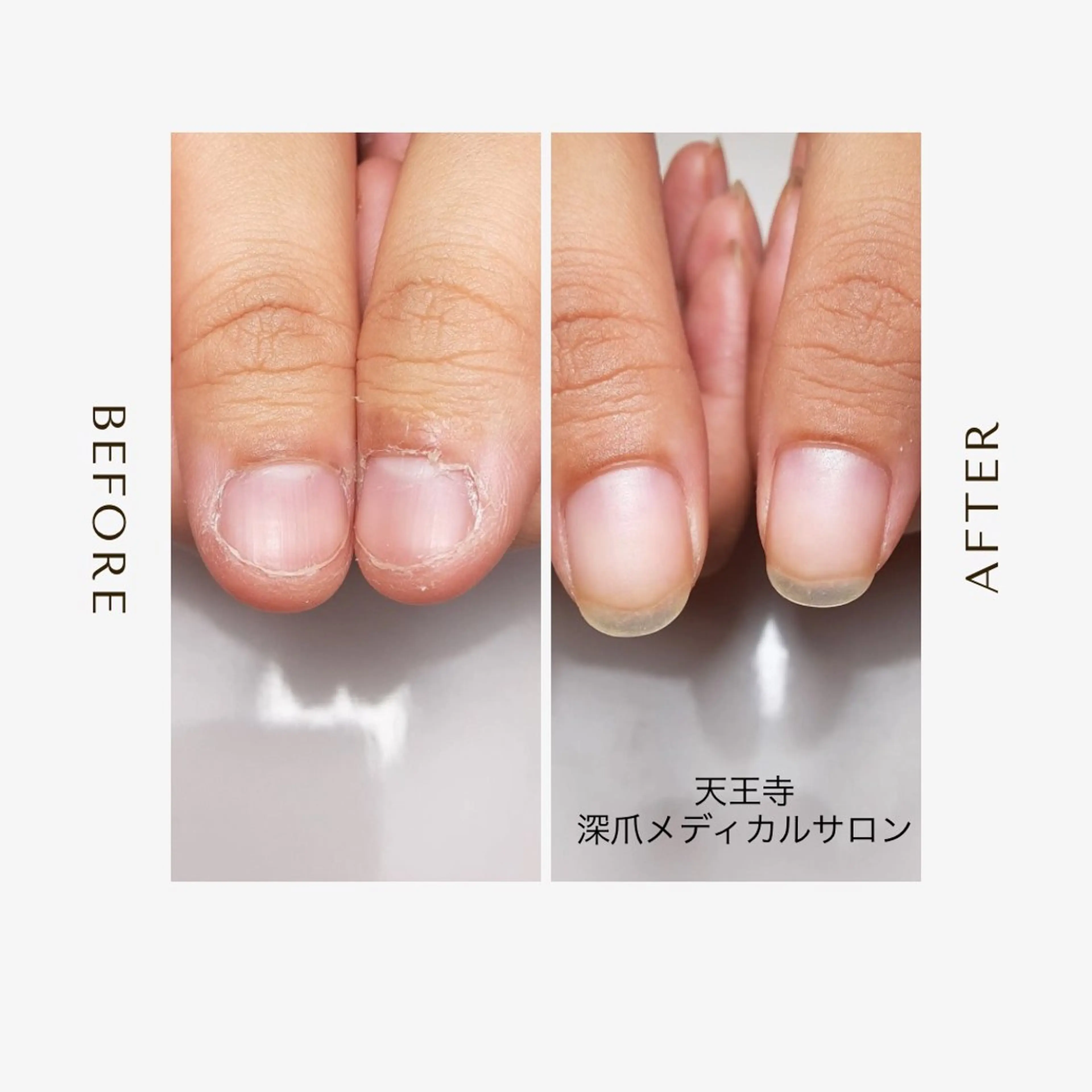 ネイル 天王寺 深爪メディカルサロンのネイルデザイン