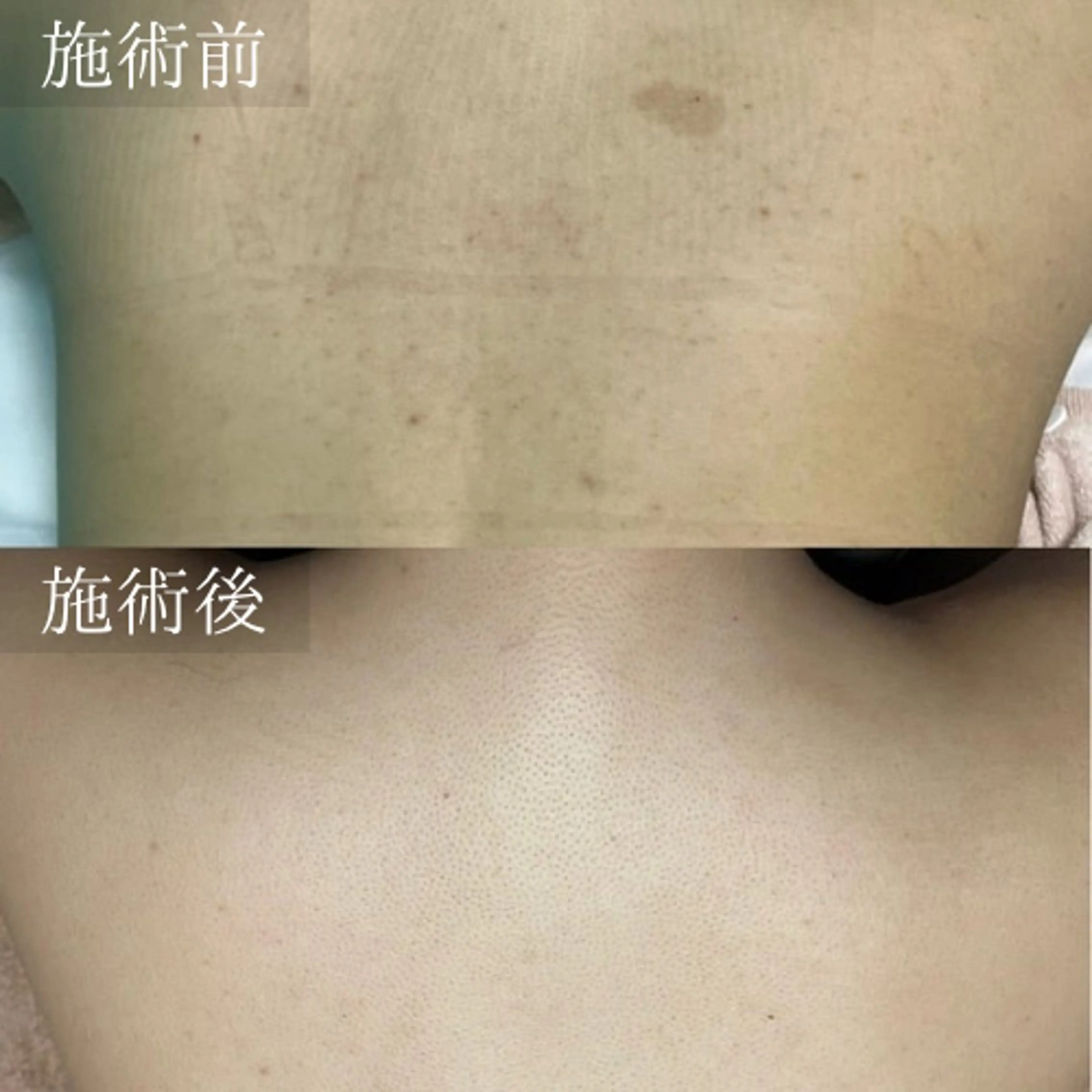 【限定クーポン⭐︎】人気No1👑全身脱毛(顔・VIO込み)¥5,000温ジェル使用の写真