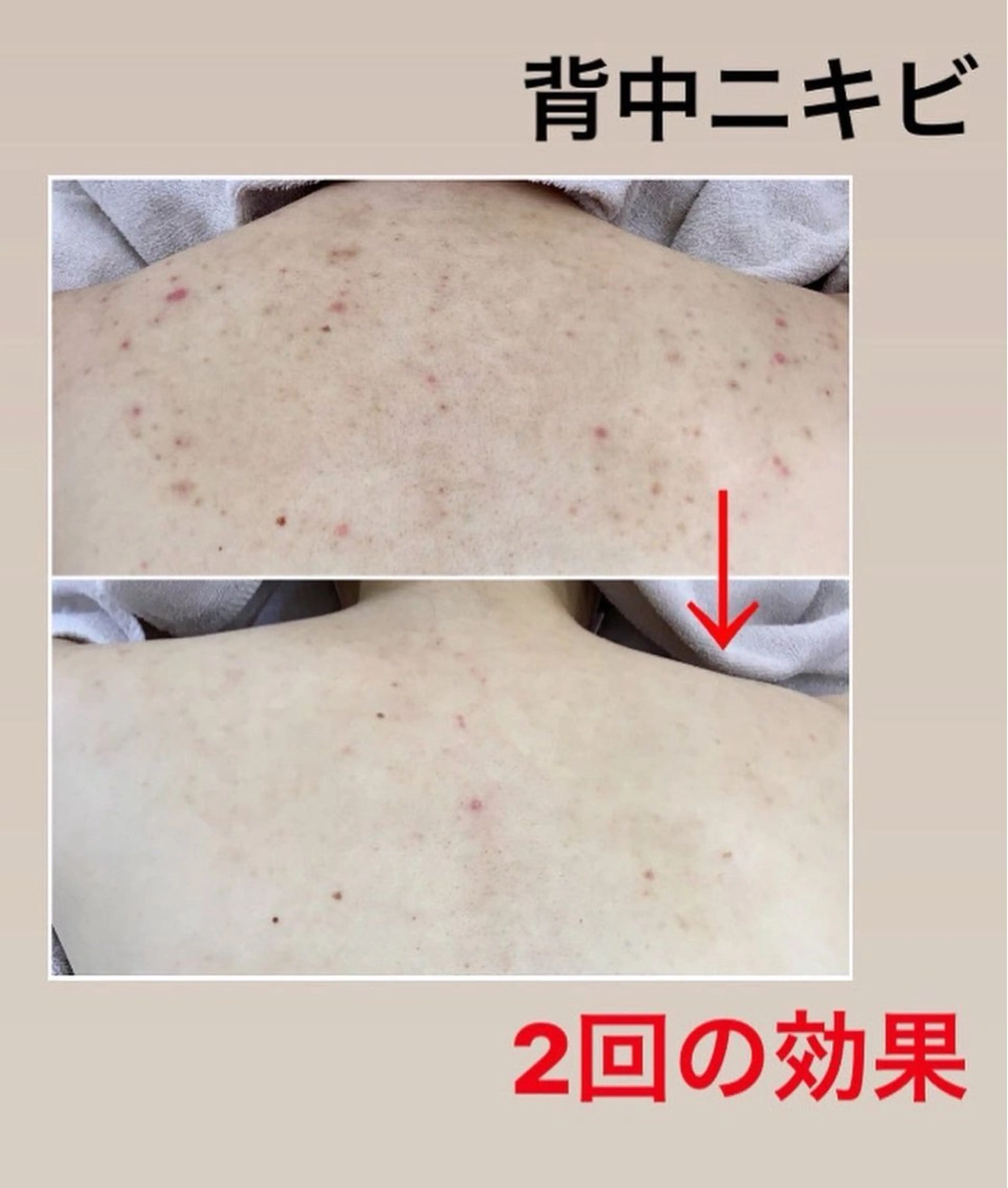 【剥離なし】背中ニキビでお悩みの方必見🩵背中ニキビ撃退ハーブピーリング🌿の写真