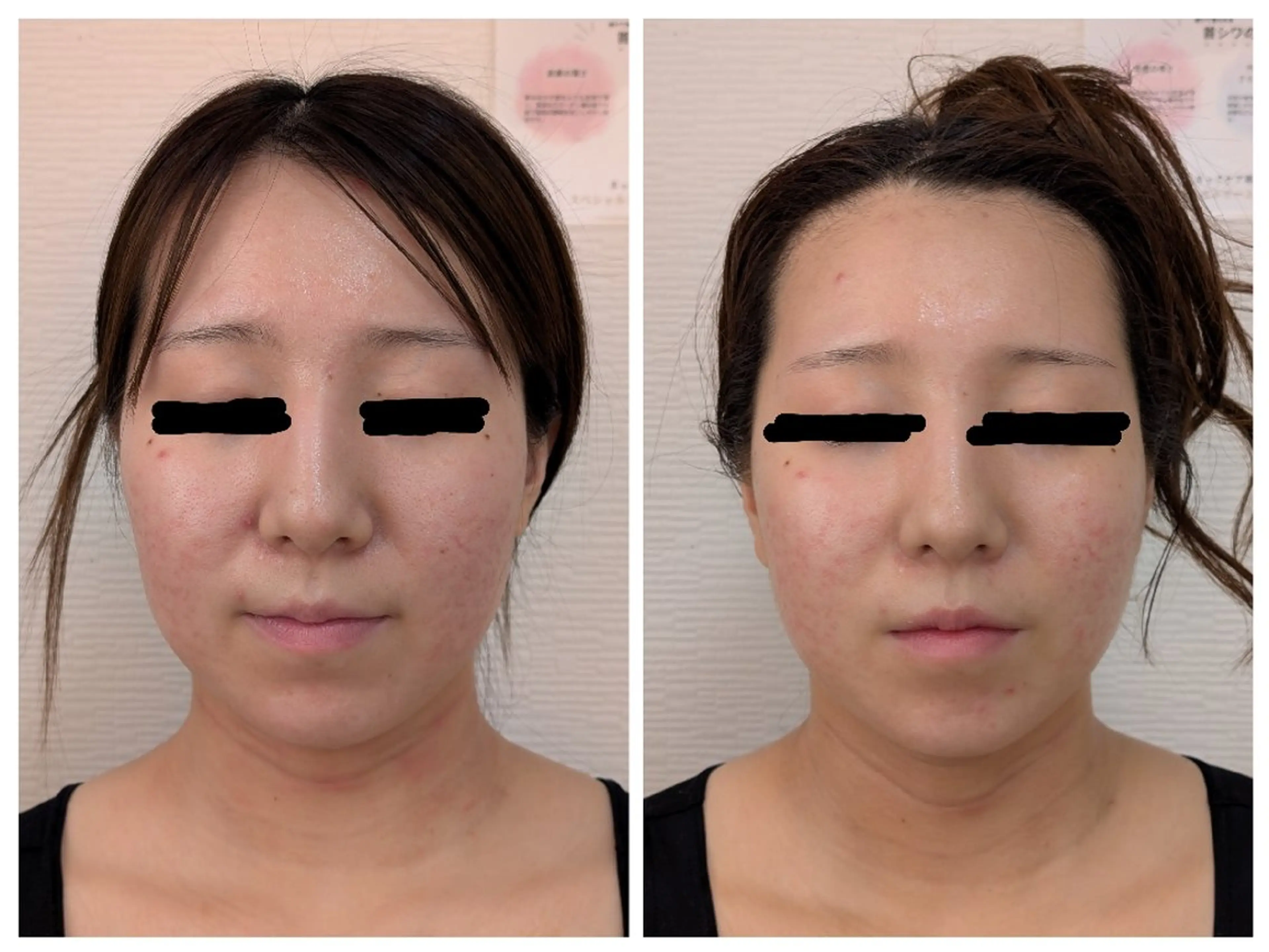 エステ レチノール/ニキビ/ 毛穴ケア　浅川のエステ・リラクイメージ