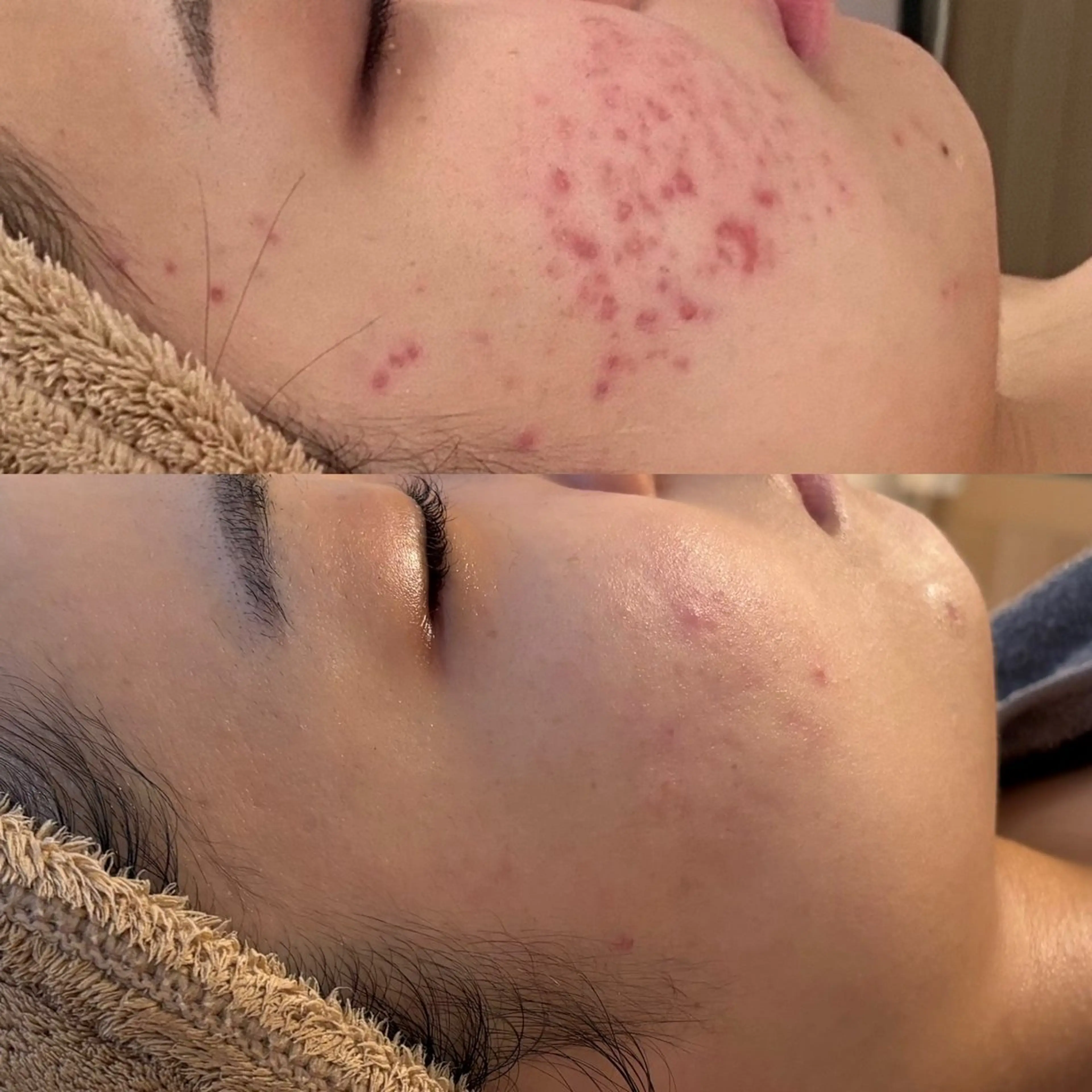 HAAB リプロ　肌質改善の写真