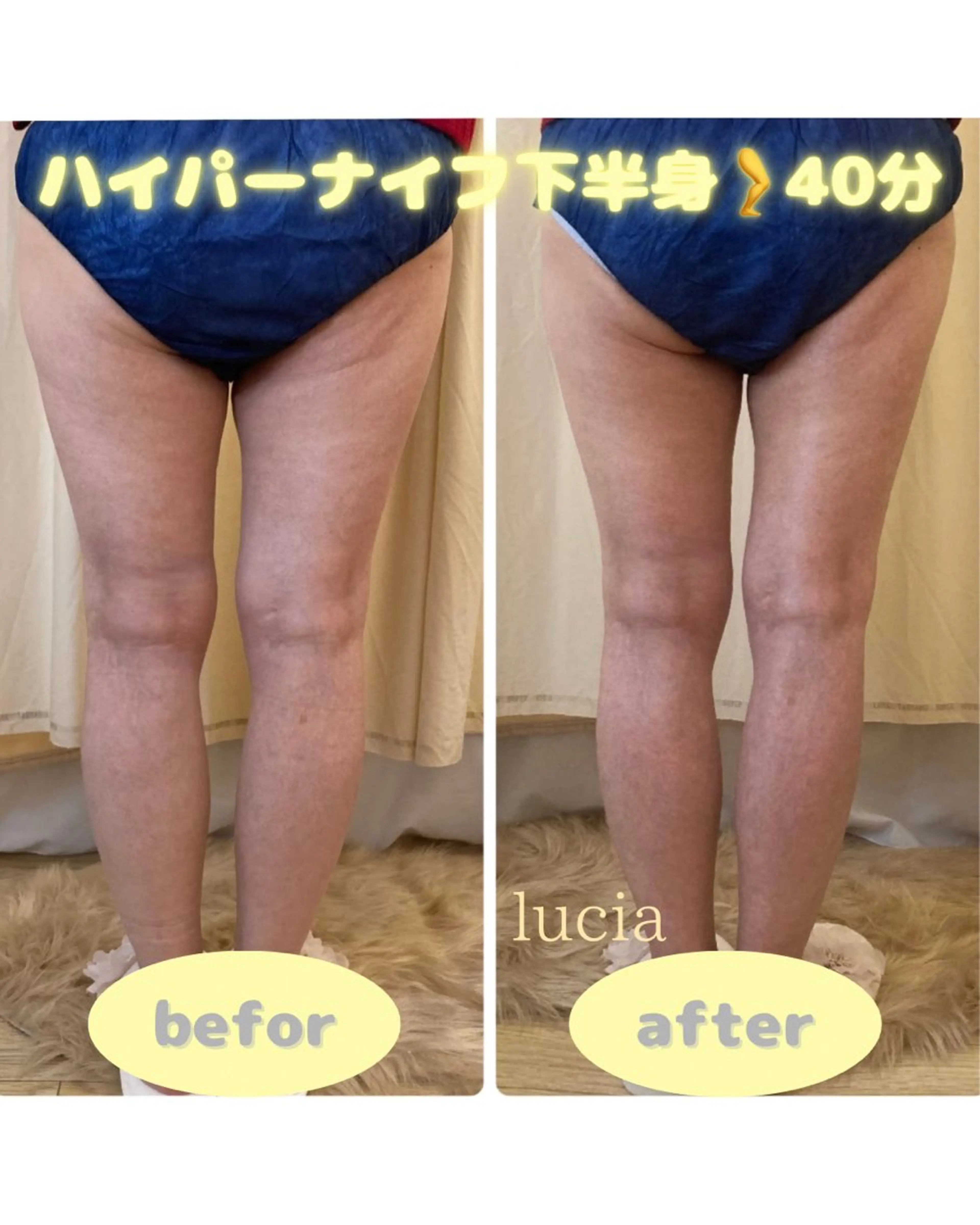 ハイパーナイフ下半身🦵＋強力リンパマッサージ✨40分の写真