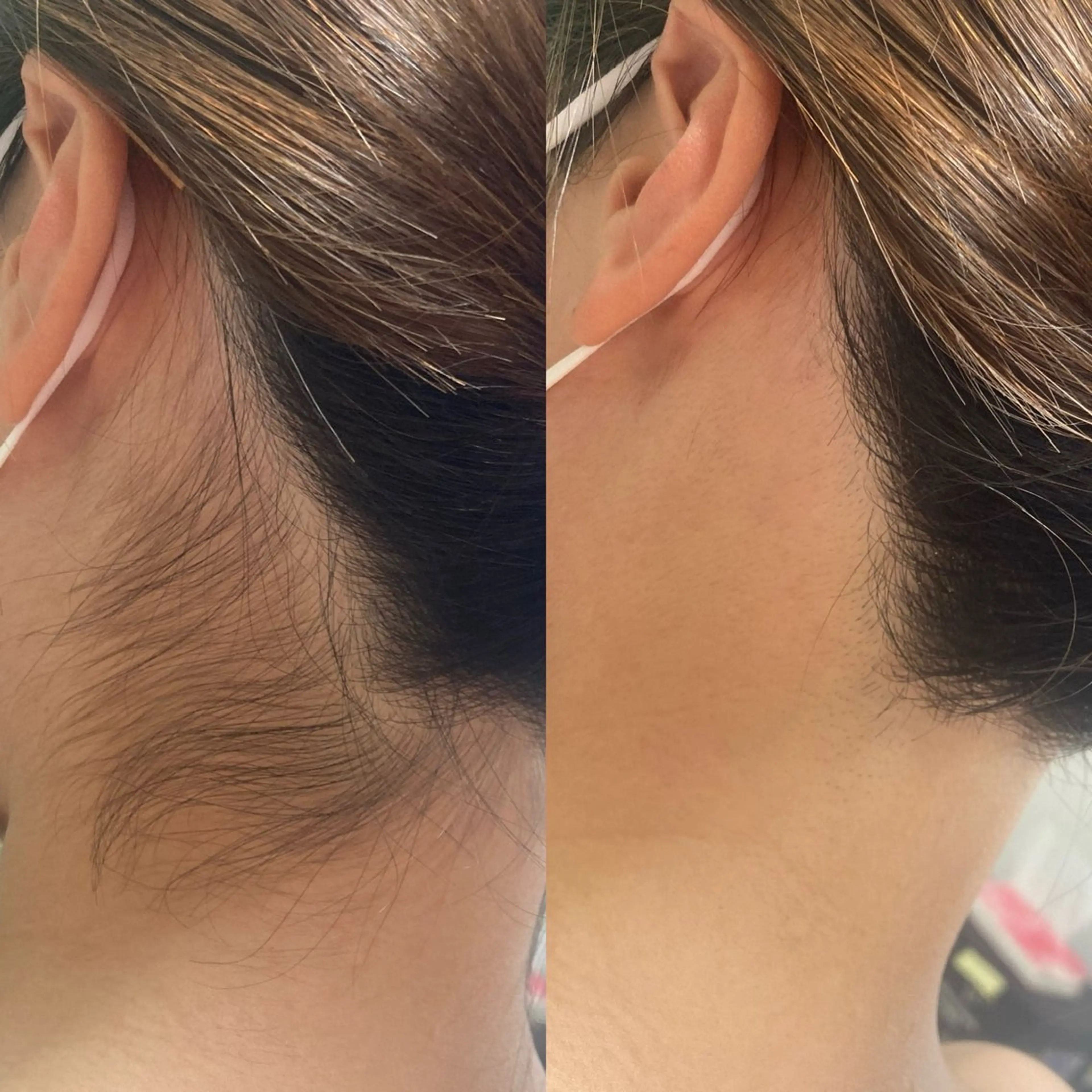 うなじシェービング＋光脱毛の写真