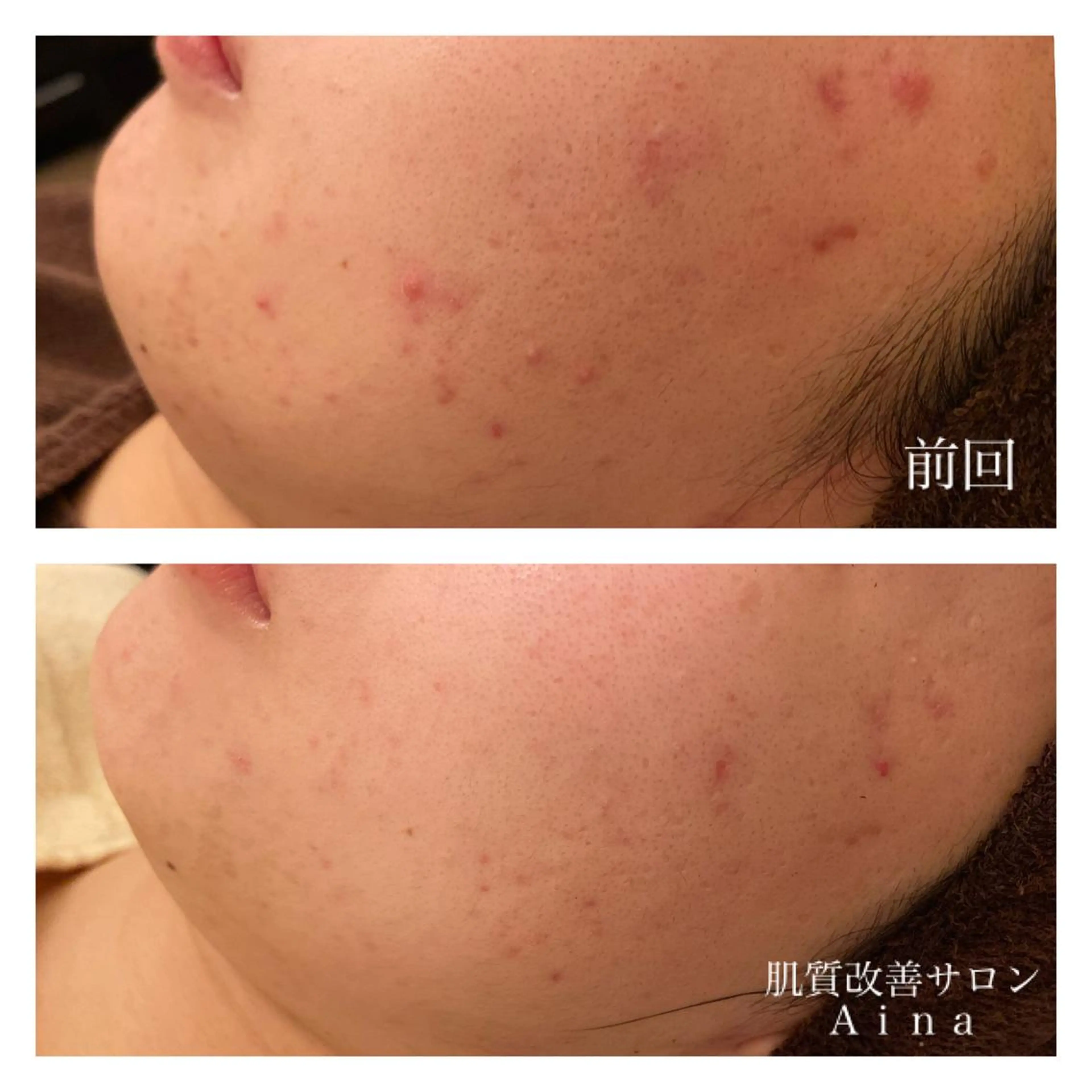 セミロング カラー パーマ ヘアアレンジ メンズ キッズ ネイル マツエク・マツパ エステ リラク ニキビ跡専門サロン Ａｉｎａのエステ・リラクイメージ