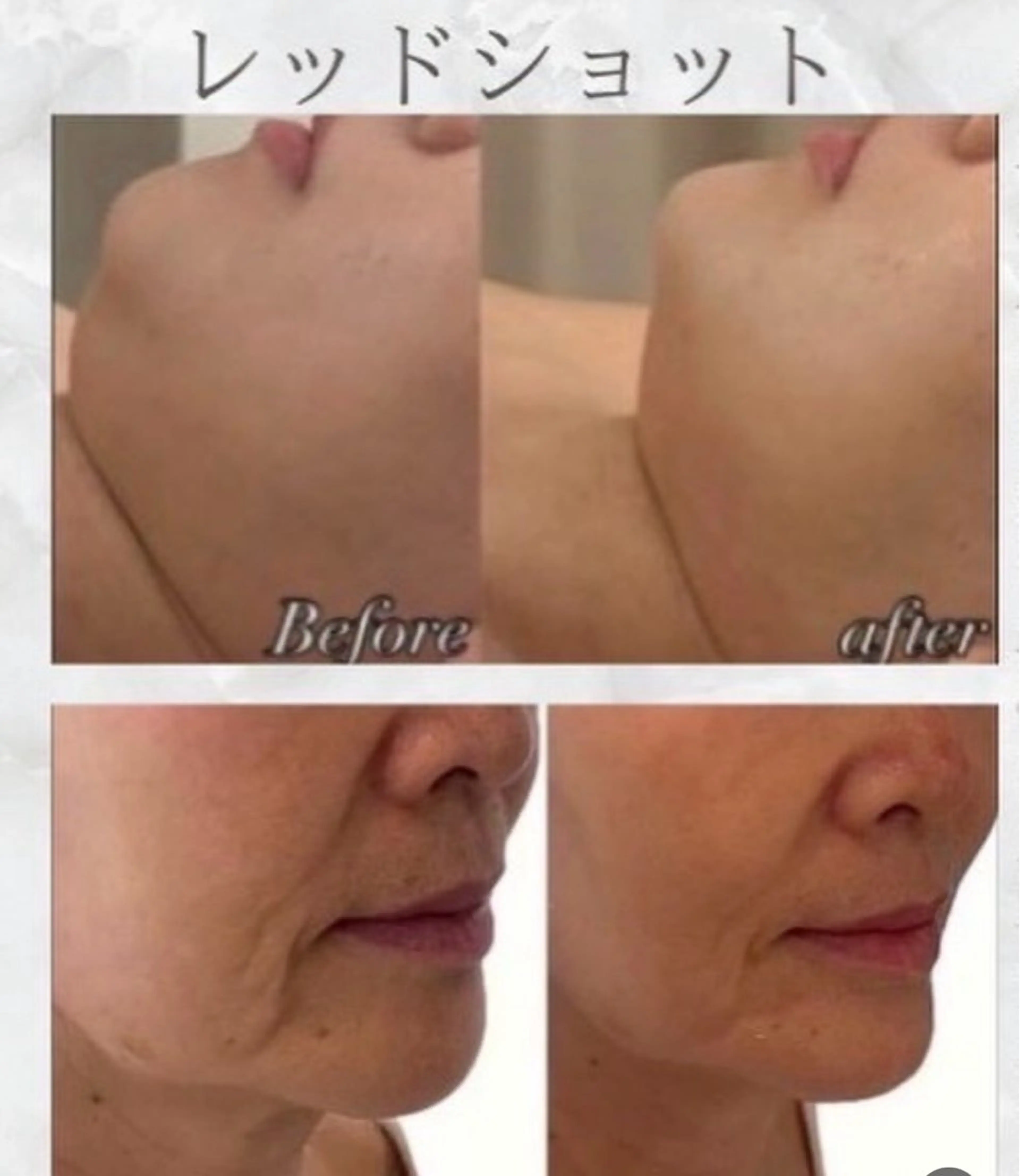 【最新!!RED SHOT】(天然成分のみでダウンタイム 1CC通常¥7,900→¥5,500の写真