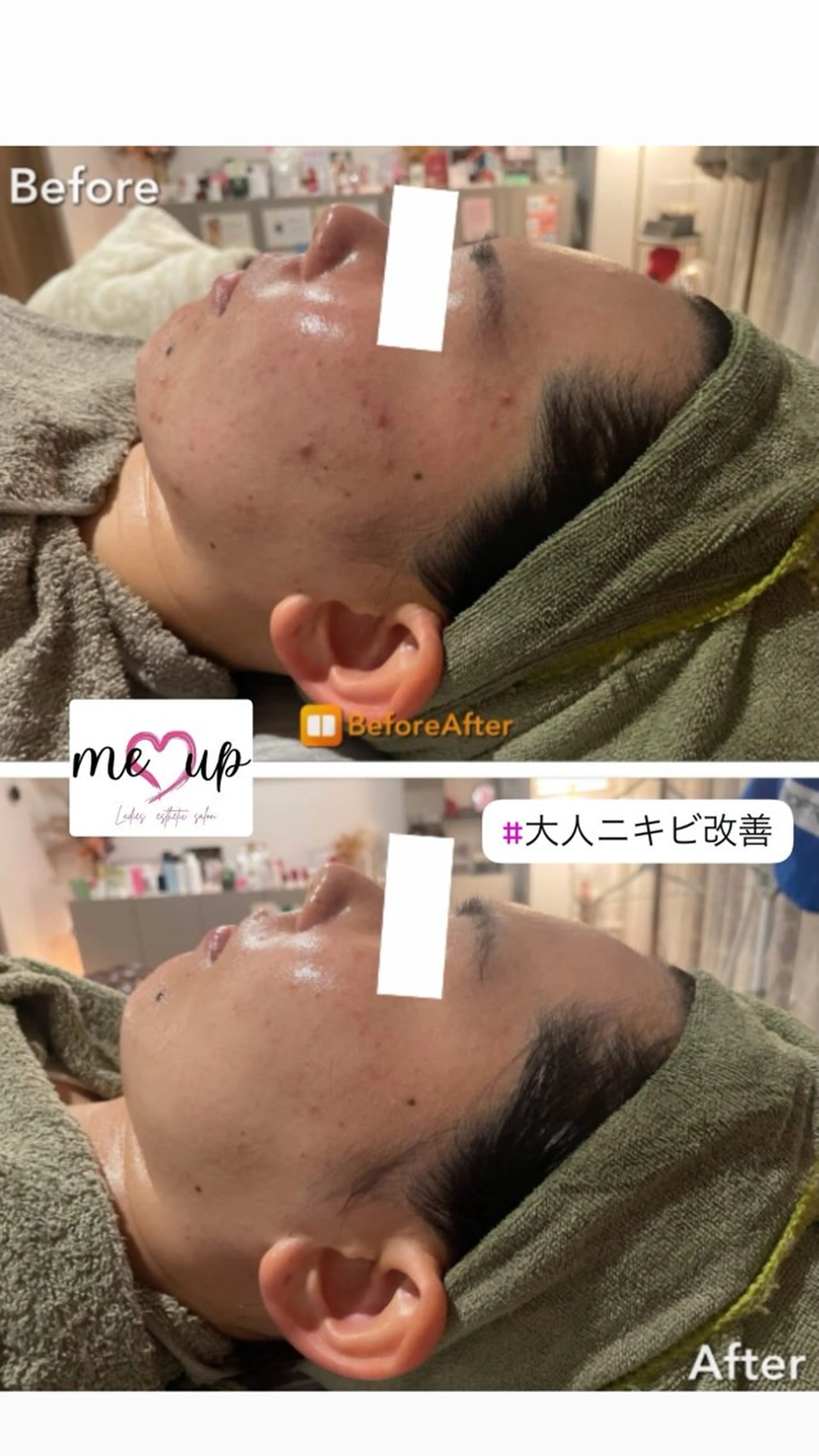 エステ Meupニキビ専門店 背中/ハーブ/肌管理のその他イメージ