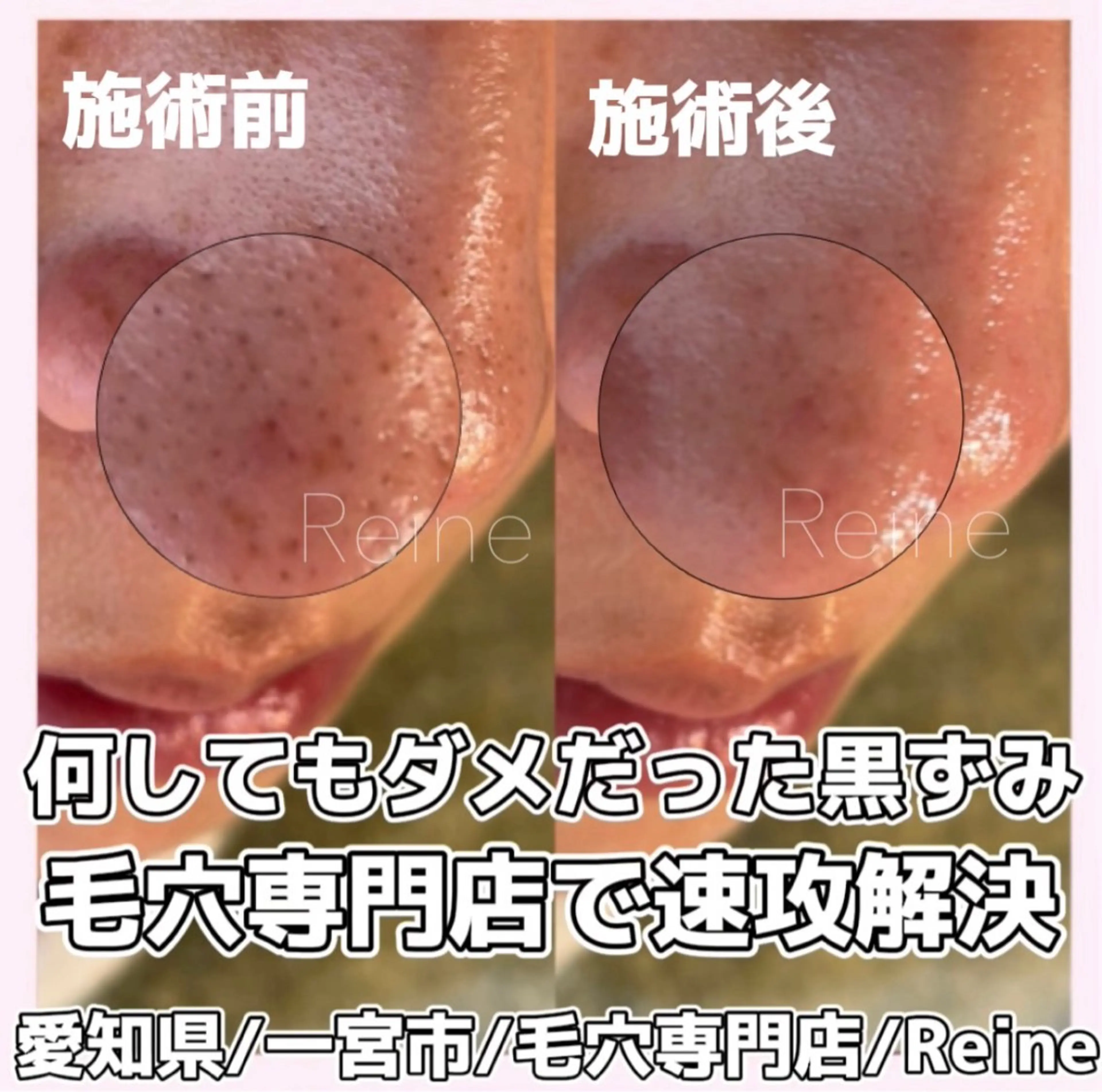 エステ Reine BeautySalon所属・毛穴/シミ肝斑/脱毛 横山梨里のエステ・リラクイメージ