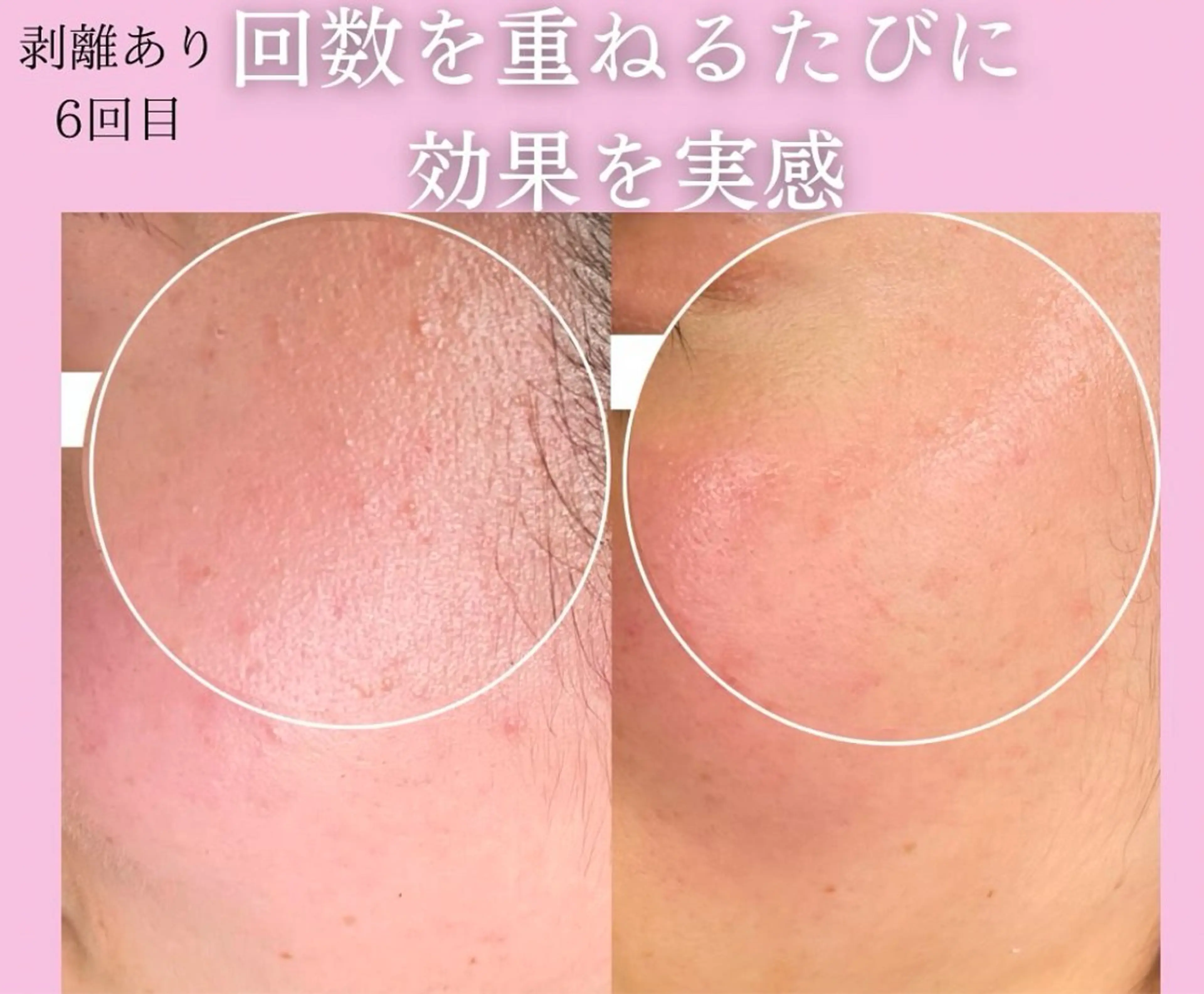 気になる部分だけケア🌟ほほのシミ・ほほニキビ・おでこのニキビ・あごニキビなど🌿気になる部分だけにハーブピーリング🌿の写真