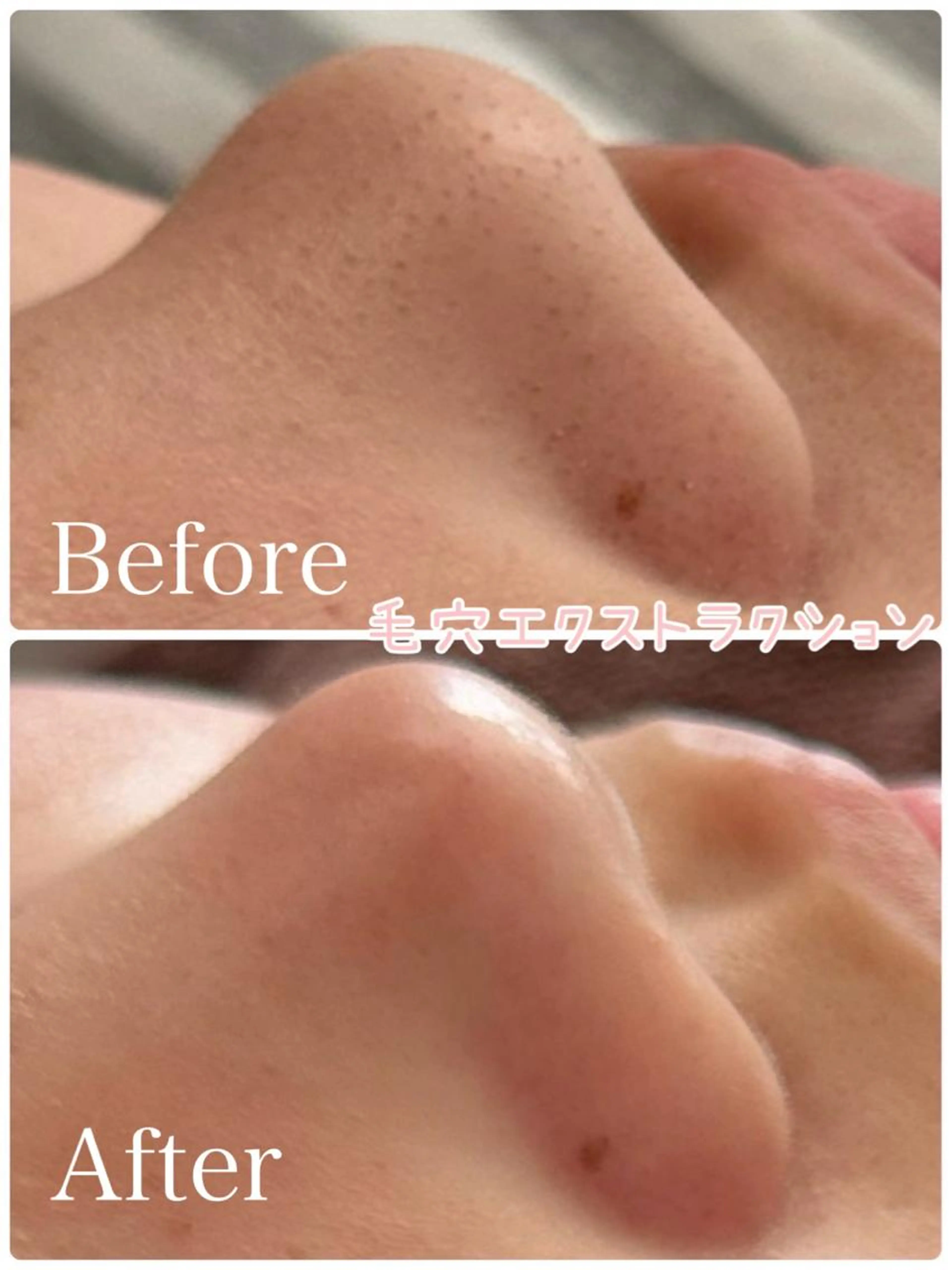 【ミニモ限定】毛穴エクストラクション美鼻コース⭐️ 《毛穴洗浄》の写真